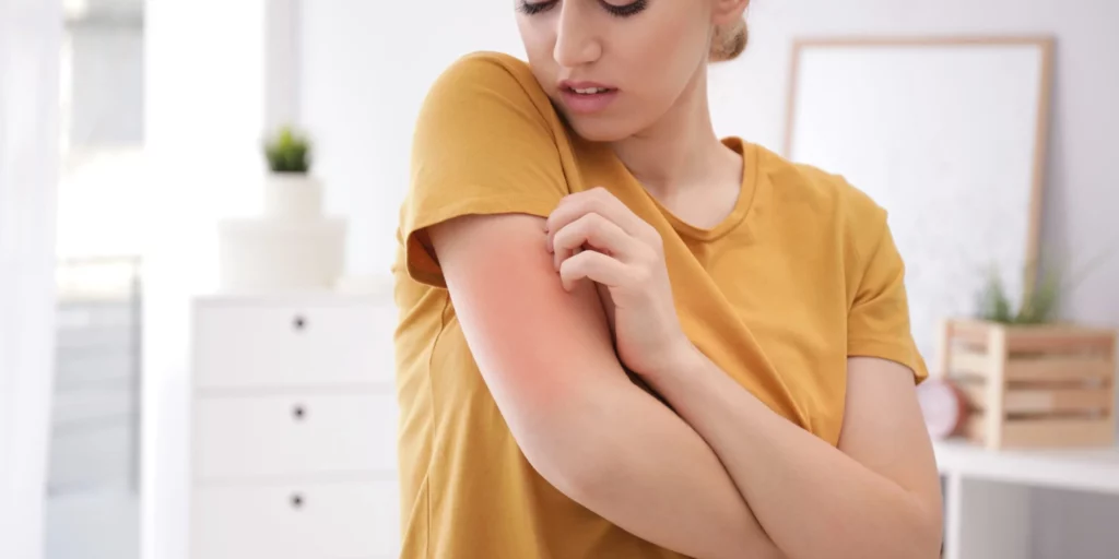 Treat Eczema In Children-burleso-TX