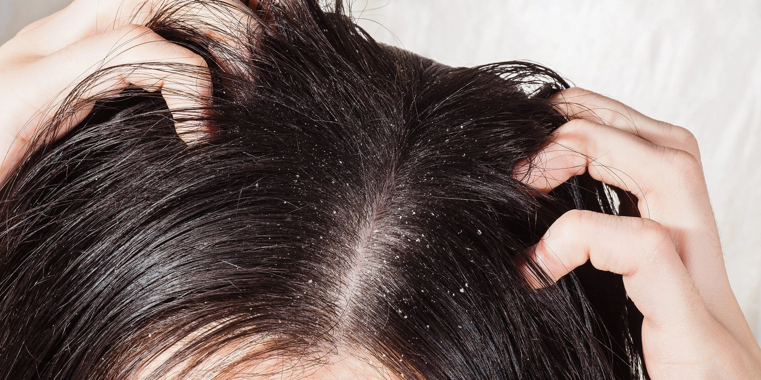 NEWEST TREATMENT FOR SCALP HEALTH-burleson-tx