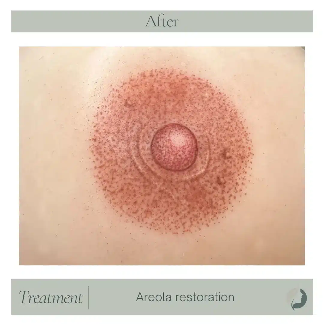 Areola-reconstruction