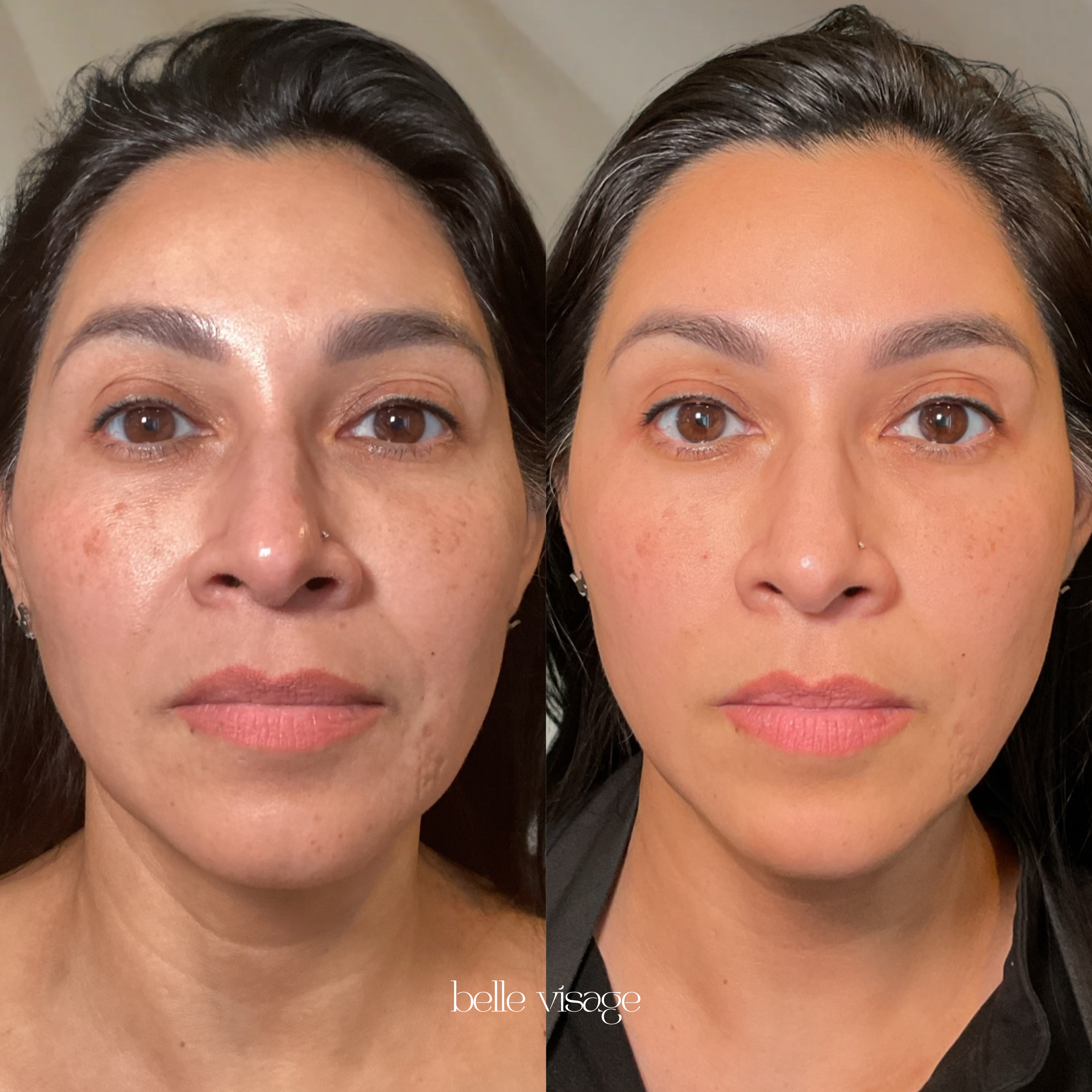 Mesotherapy Microneedling Treatment Burleson TX