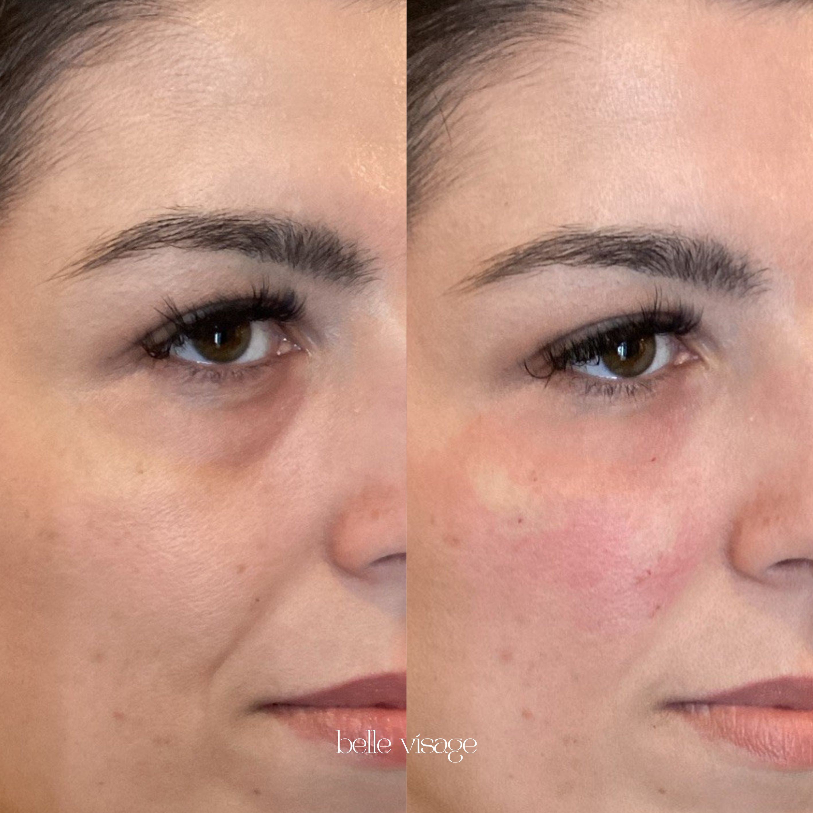 Bio Filler EZ Gel PRF Biostimulator Injectable Treatment Burleson TX