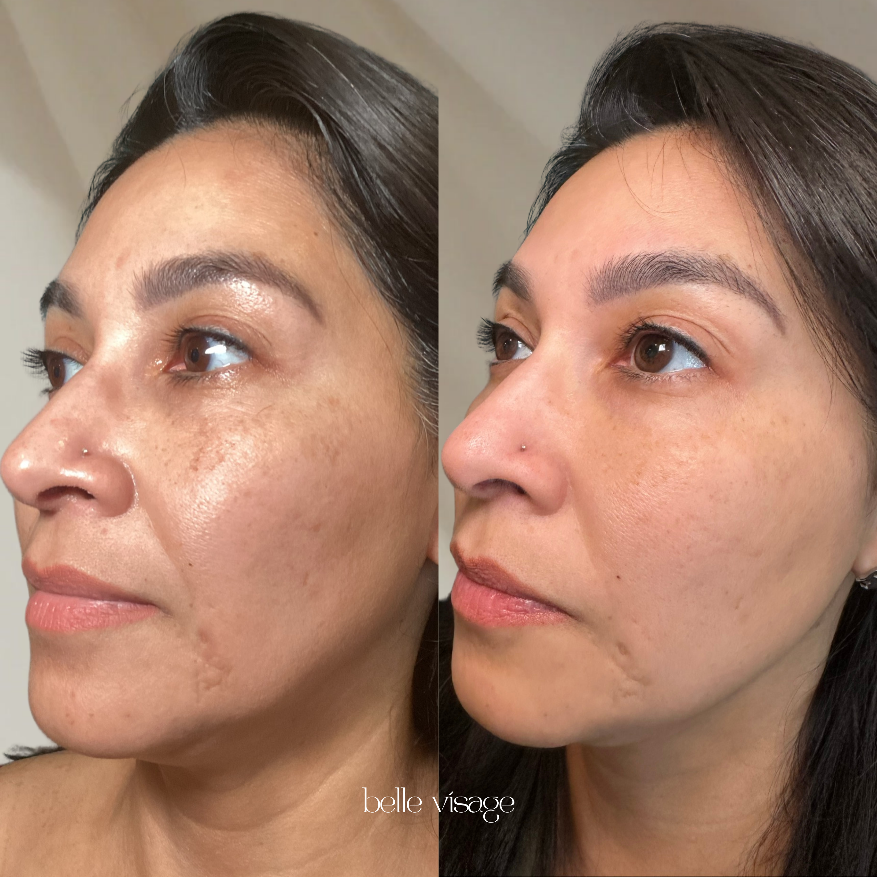 Mesotherapy Microneedling Treatment Burleson TX