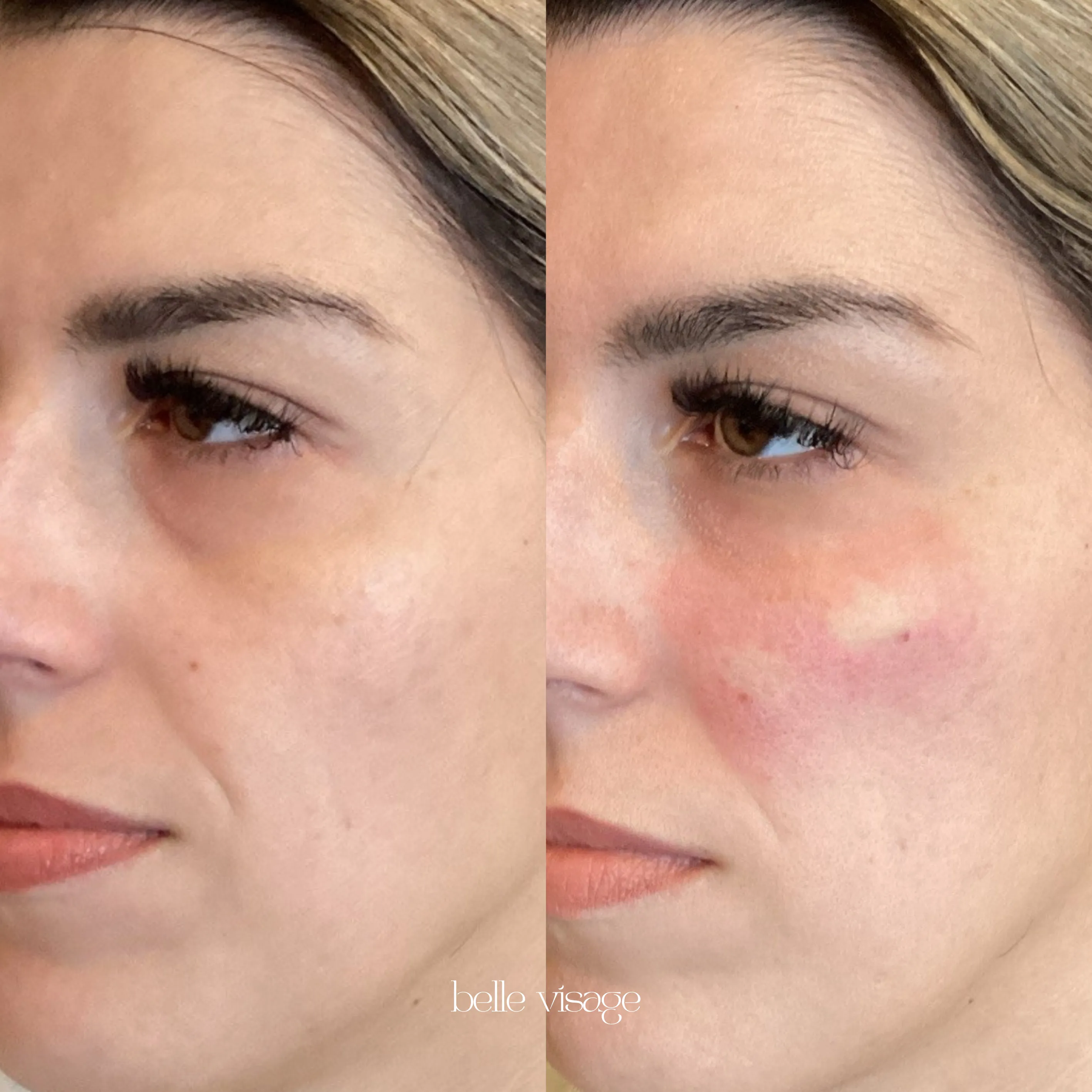 Bio Filler EZ Gel PRF Biostimulator Injectable Treatment Burleson TX