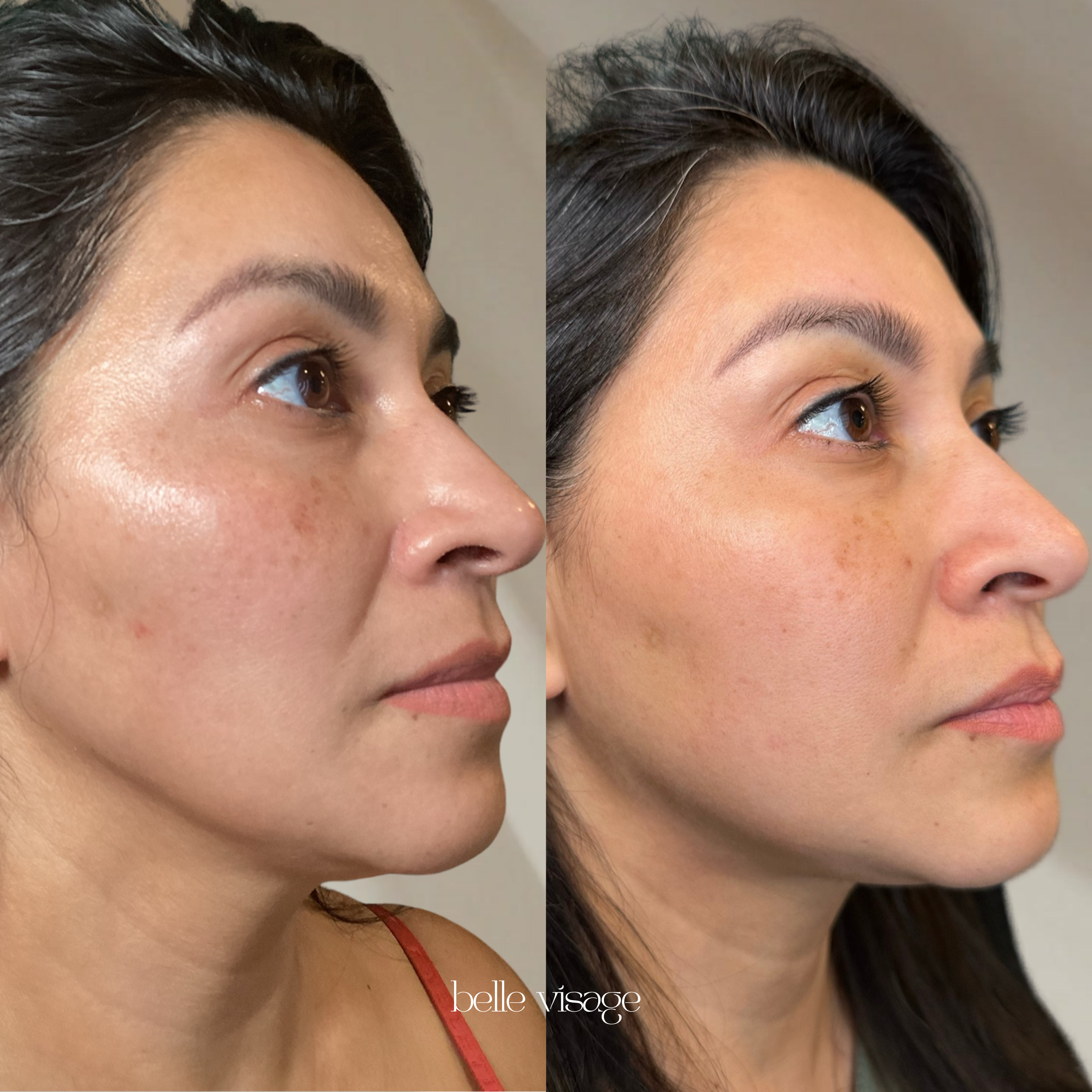 Mesotherapy Microneedling Treatment Burleson TX