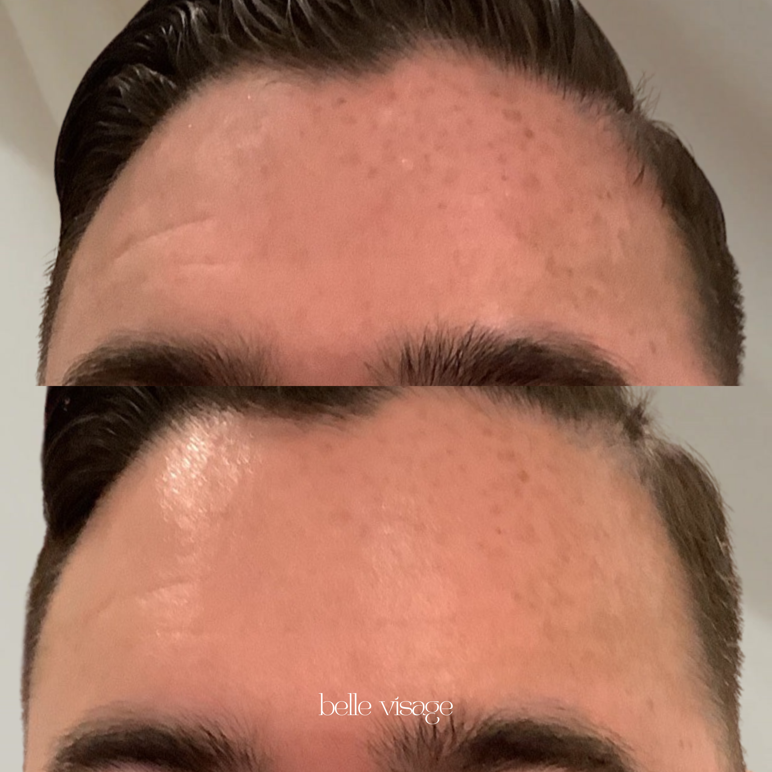 Microneedling Treatment Burleson TX