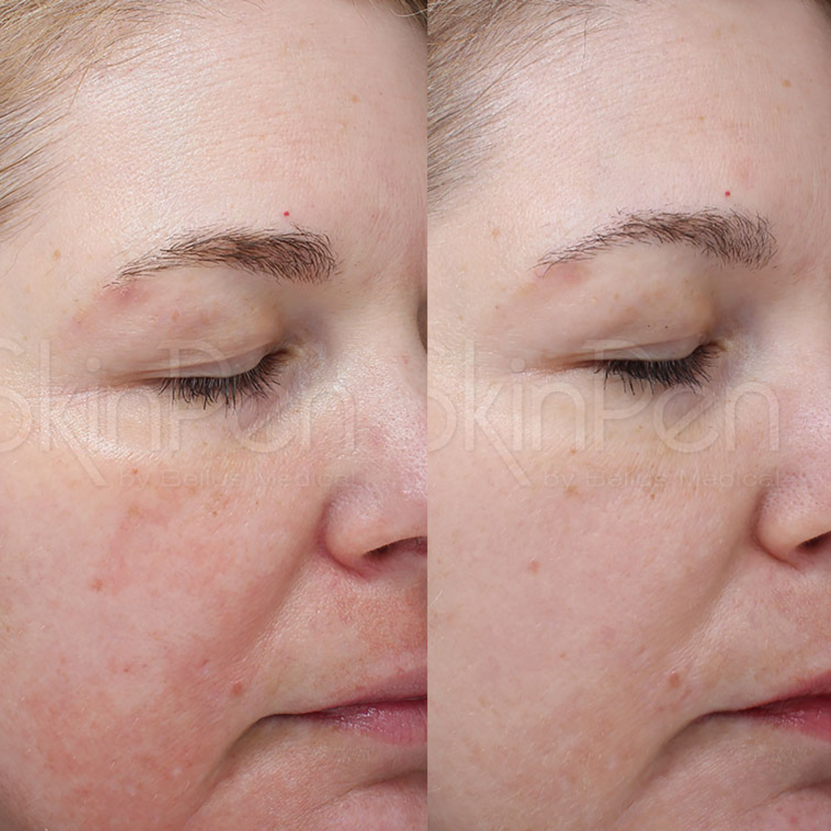 Microneedling Treatment Burleson TX