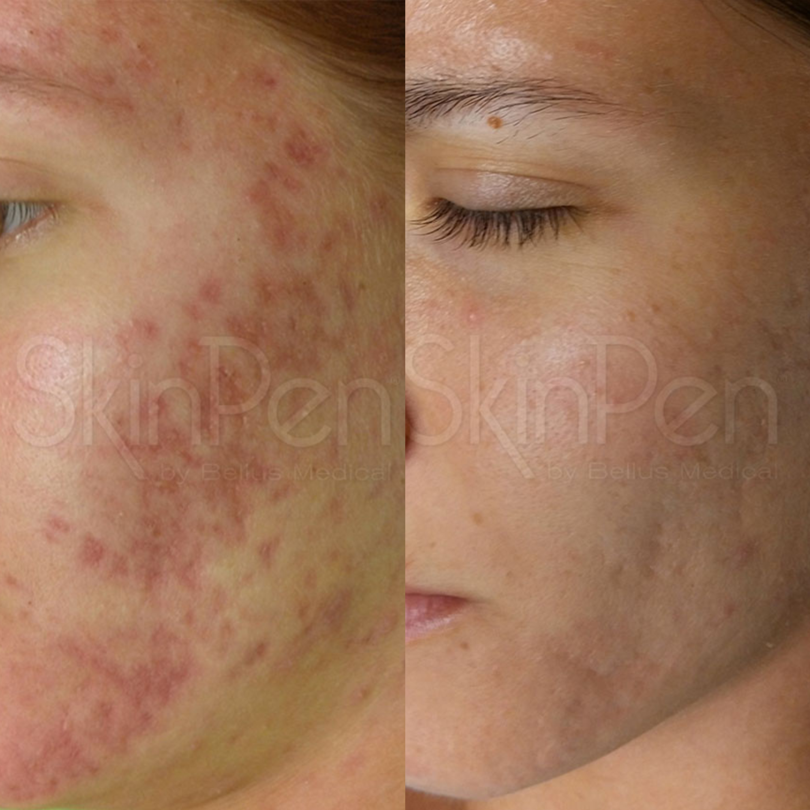 Microneedling Treatment Burleson TX