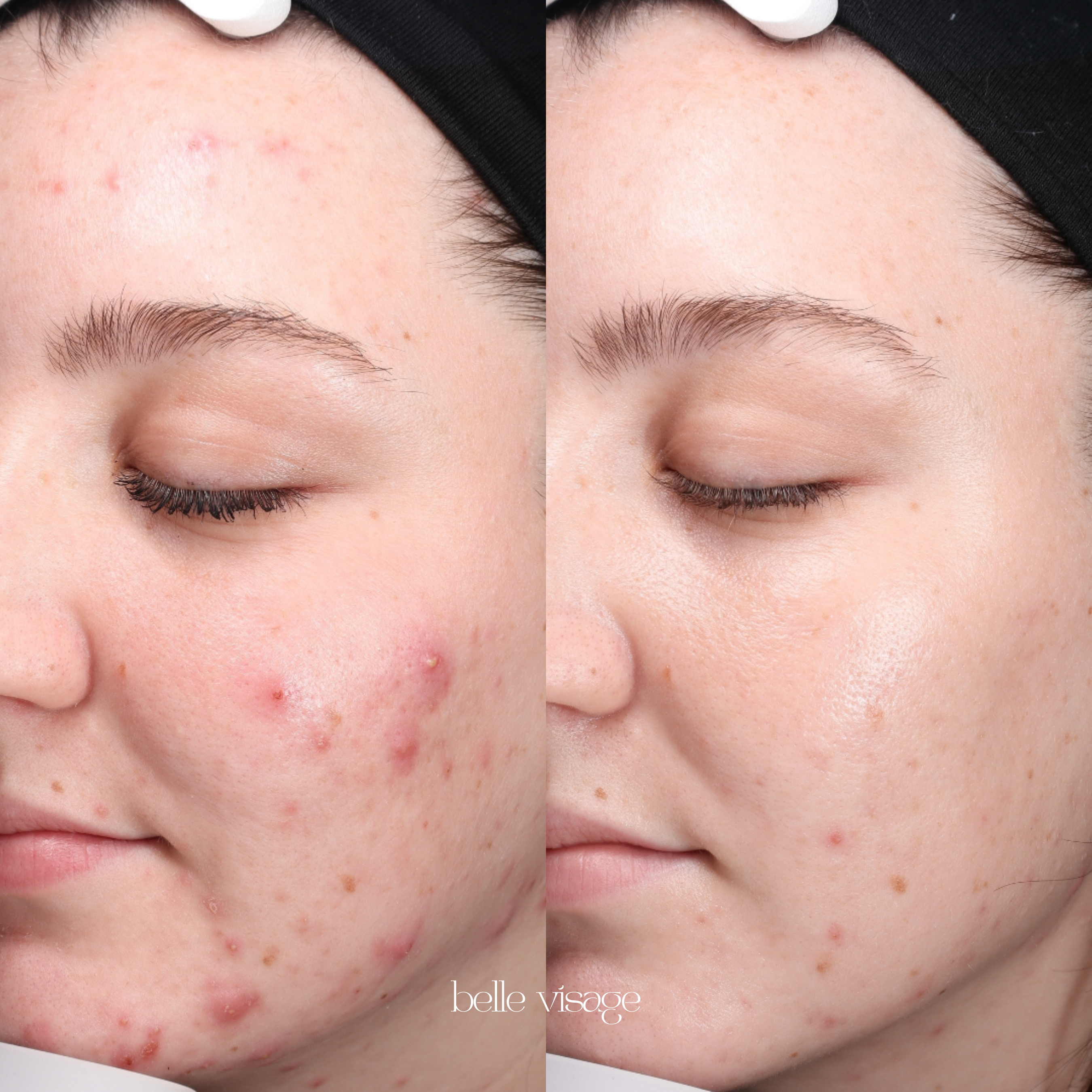 acne bootcamp treatment burleson tx