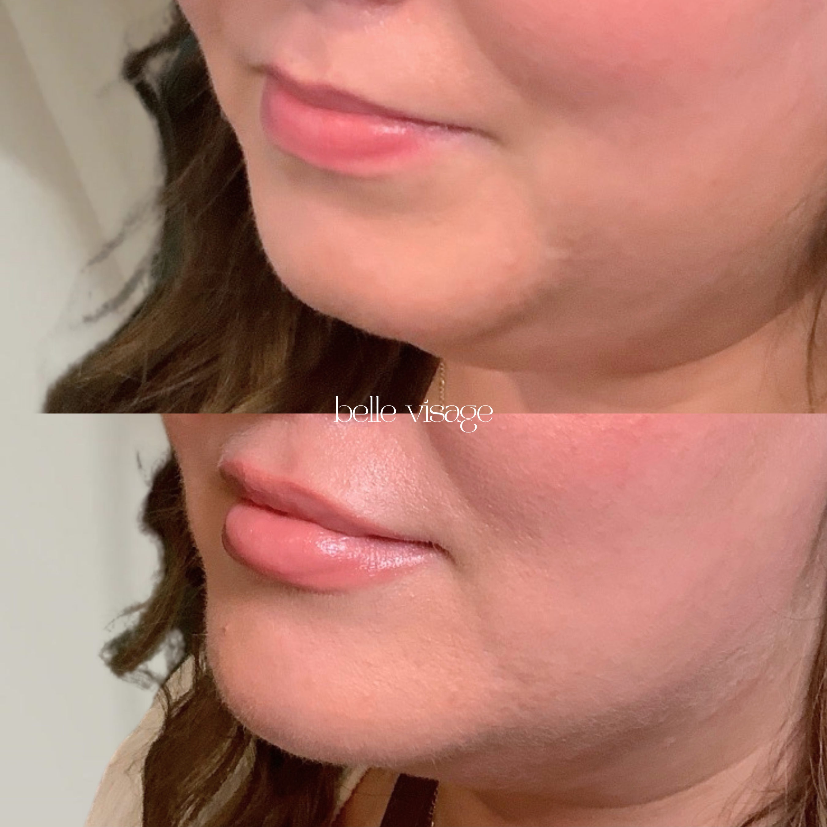 Filler Injectable Treatment Burleson TX
