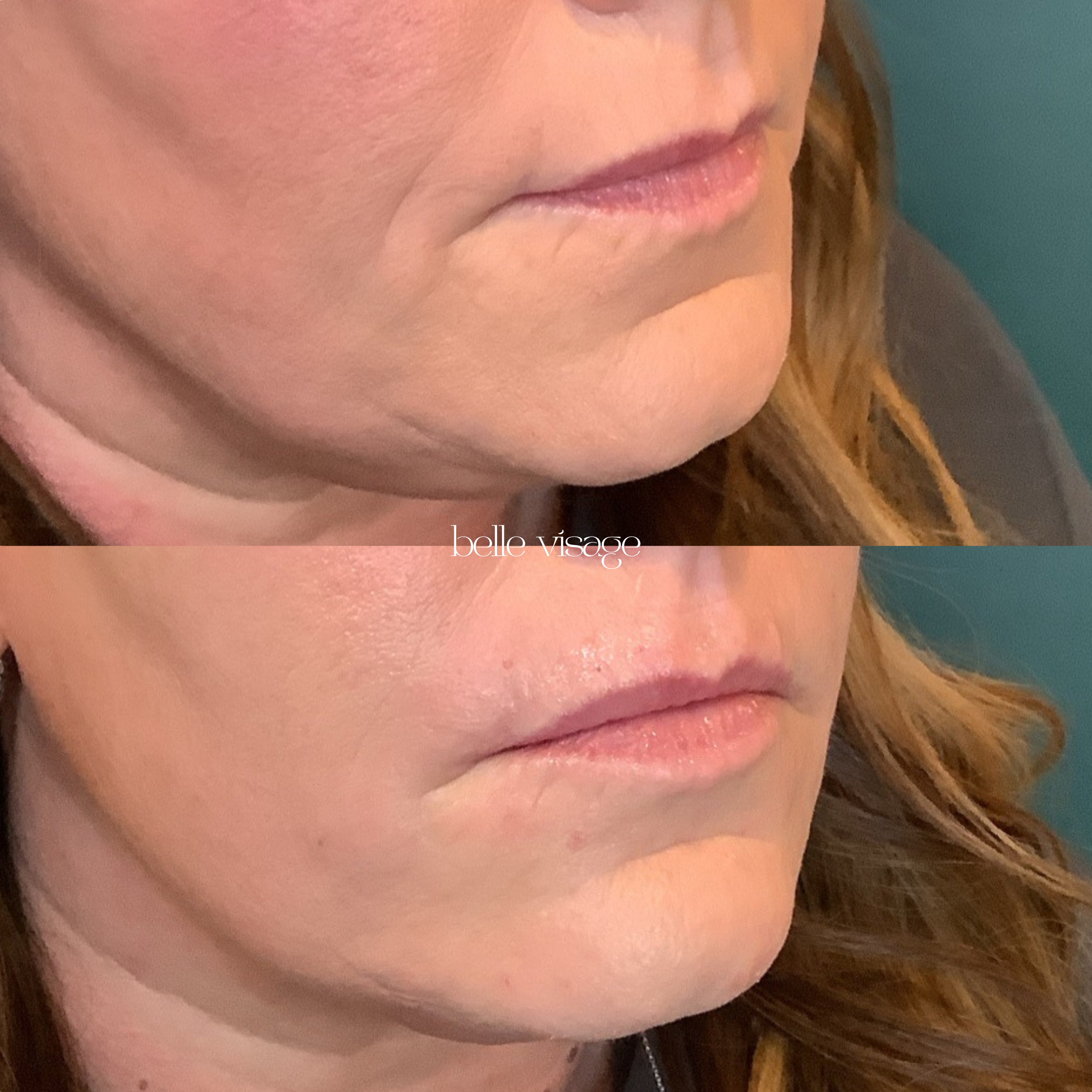 Bio Filler EZ Gel PRF Biostimulator Injectable Treatment Burleson TX