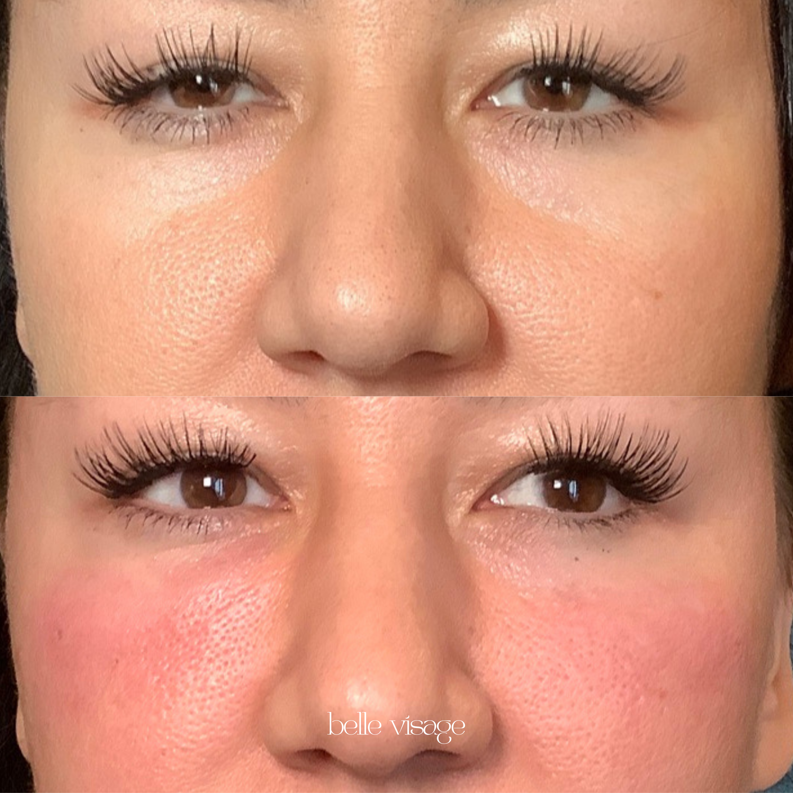 Bio Filler EZ Gel PRF Biostimulator Injectable Treatment Burleson TX