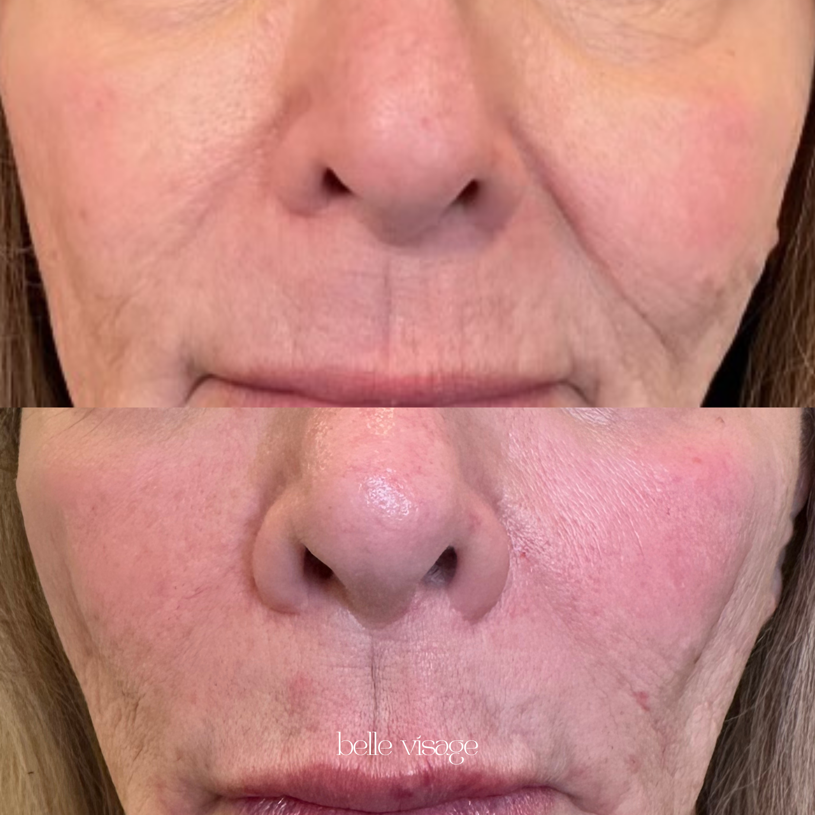 Bio Filler EZ Gel PRF Biostimulator Injectable Treatment Burleson TX