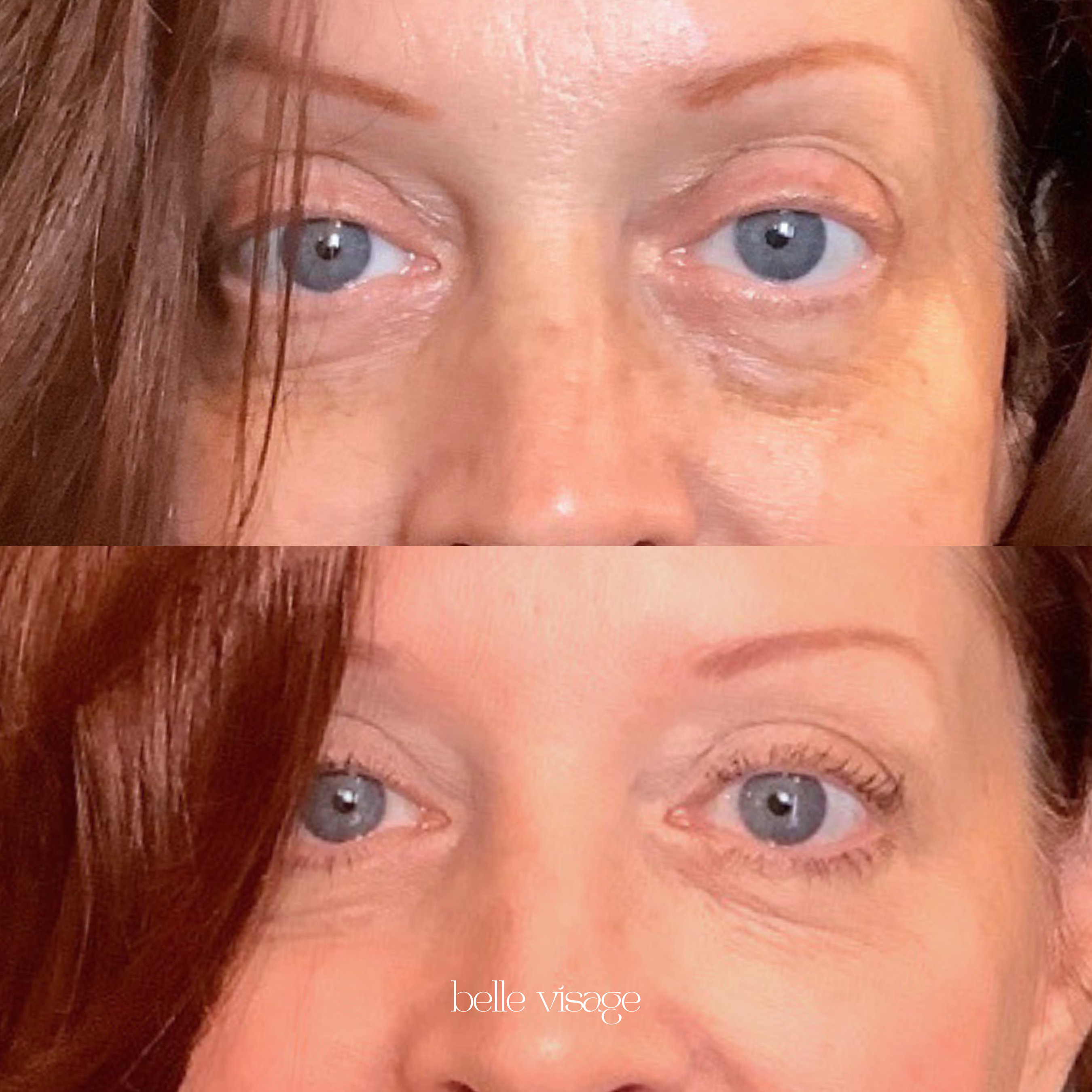 Bio Filler EZ Gel PRF Biostimulator Injectable Treatment Burleson TX