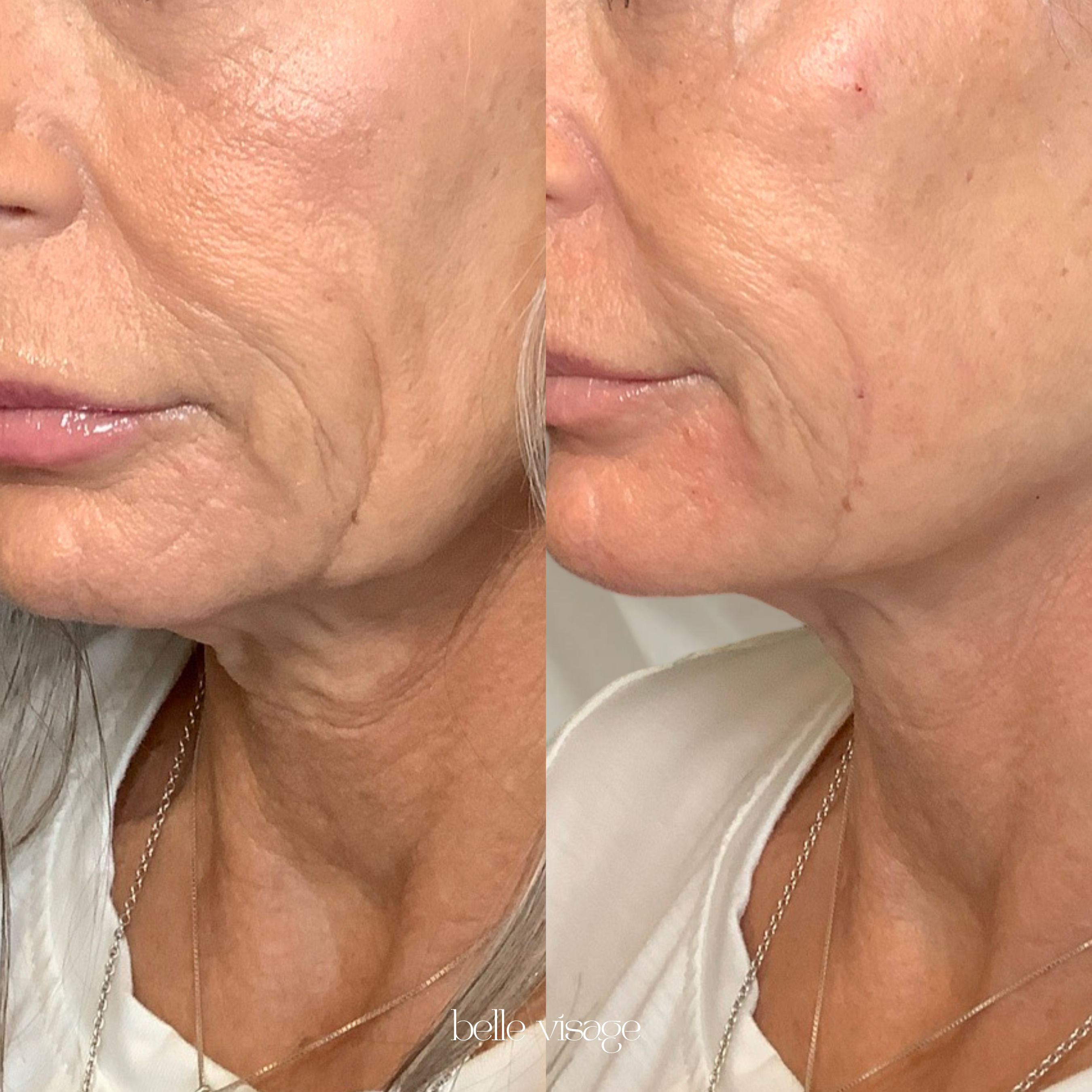 Bio Filler EZ Gel PRF Biostimulator Injectable Treatment Burleson TX