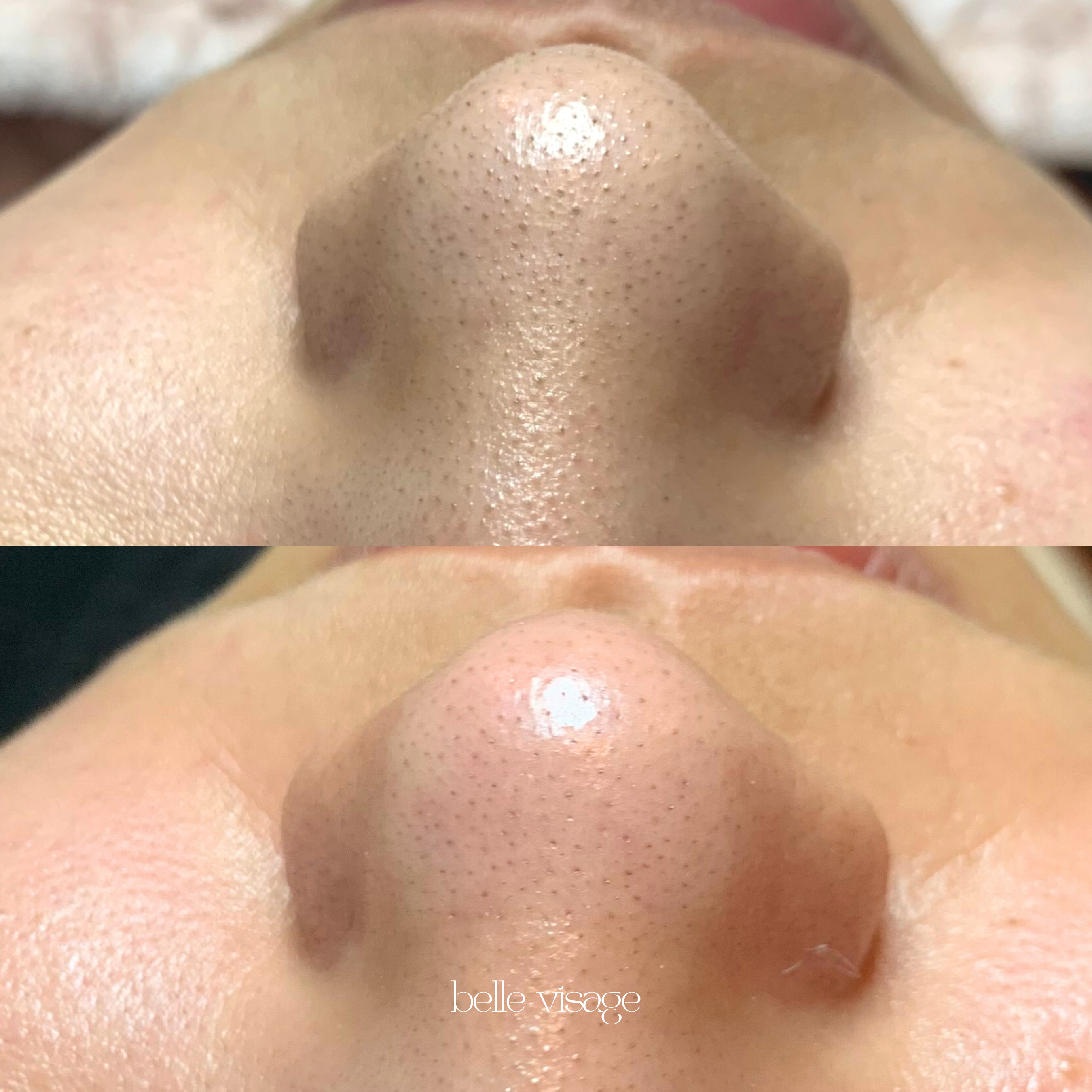 hydrafacial pore cleansing extractions burleson tx