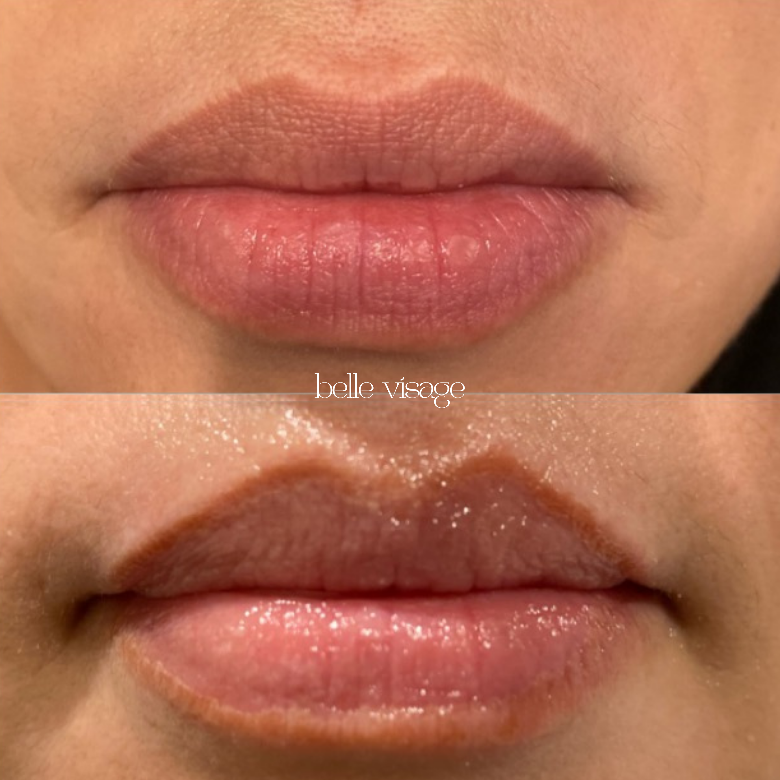 Lip Filler Treatment Burleson TX