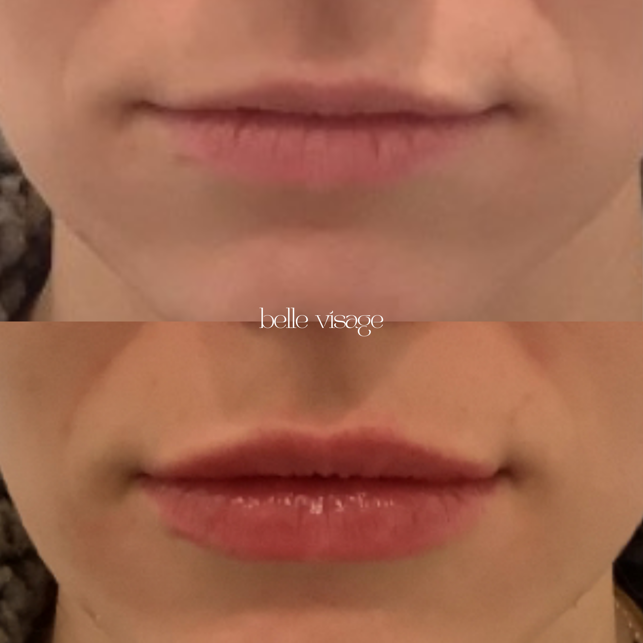 Lip Filler Treatment Burleson TX