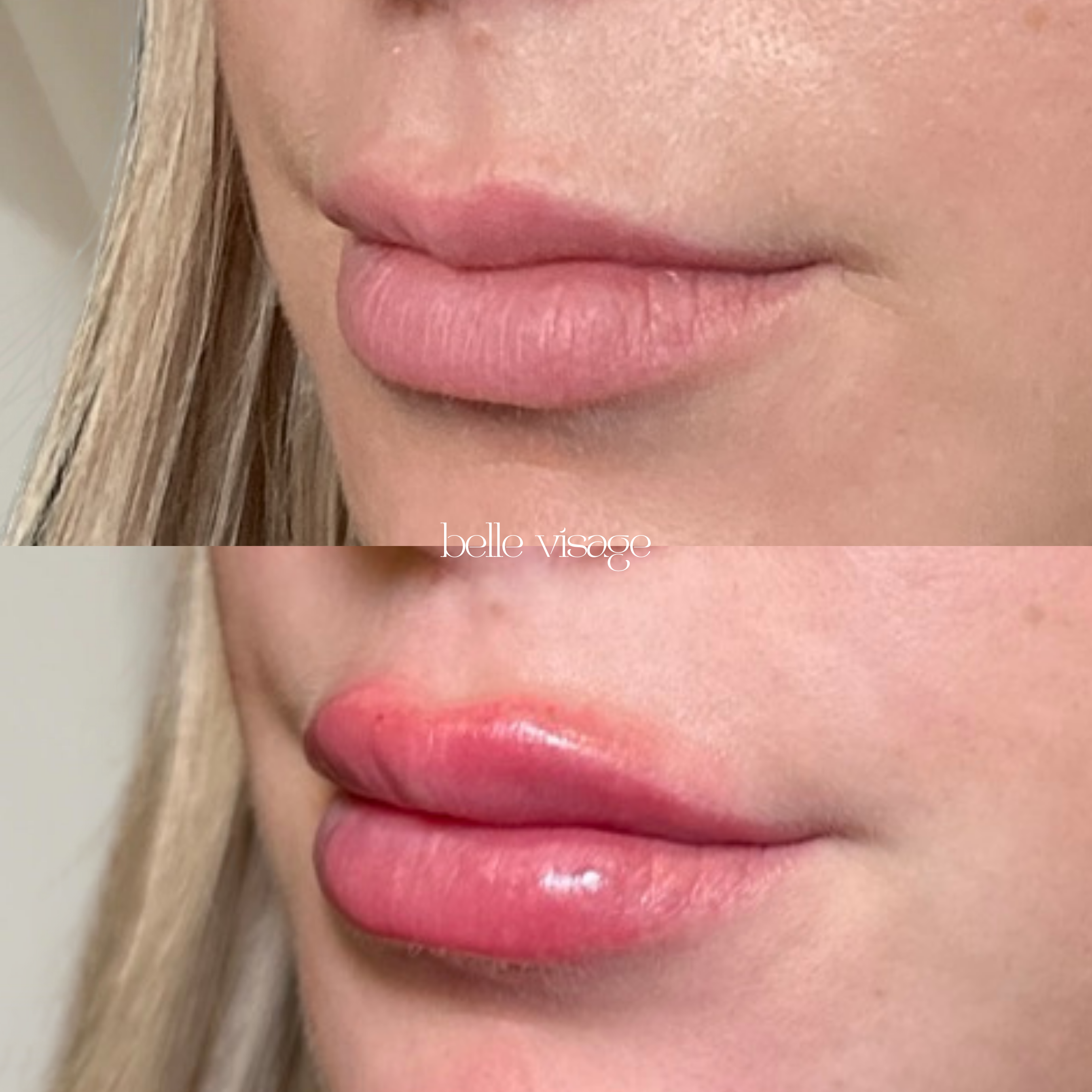 Lip Filler Treatment Burleson TX