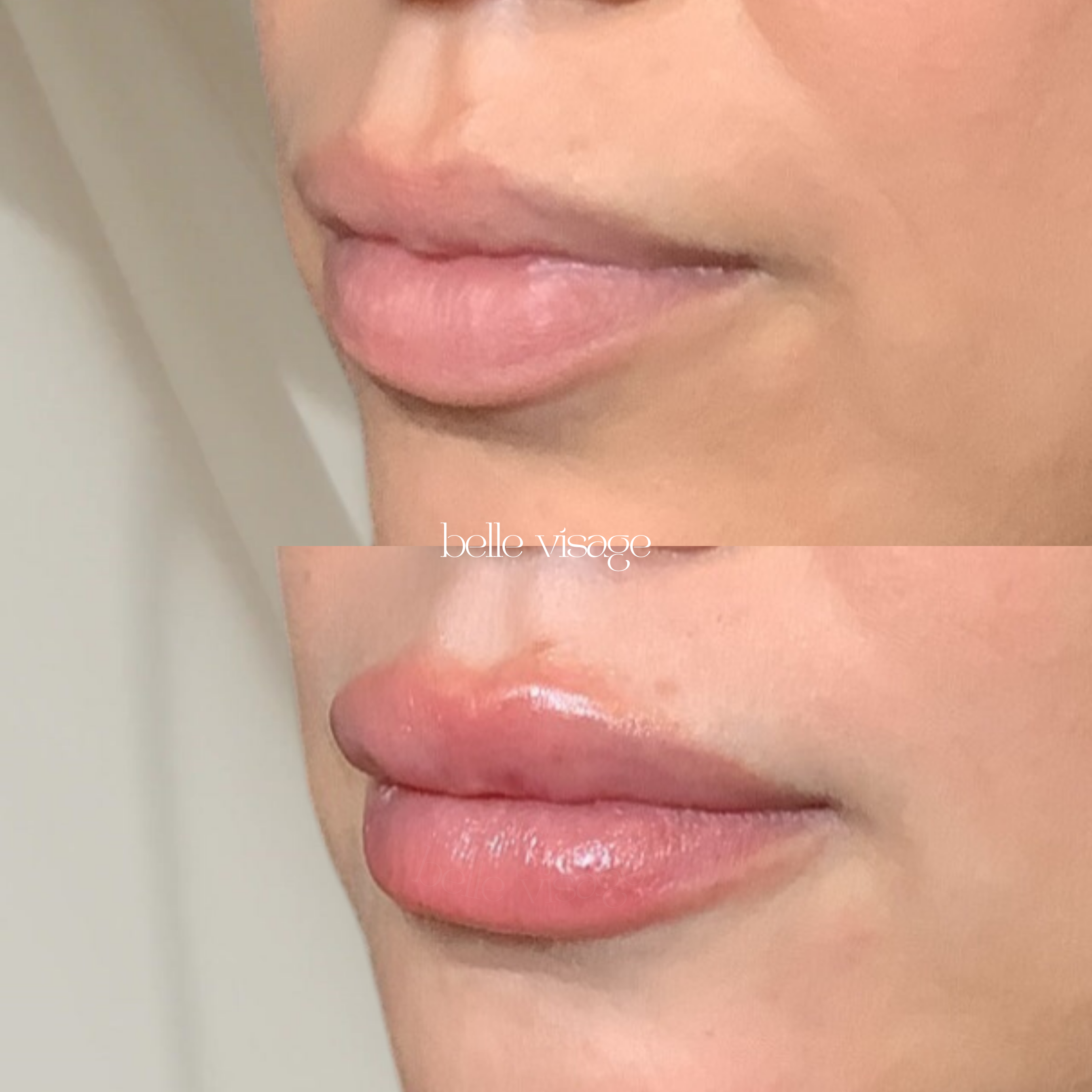 Lip Filler Treatment Burleson TX