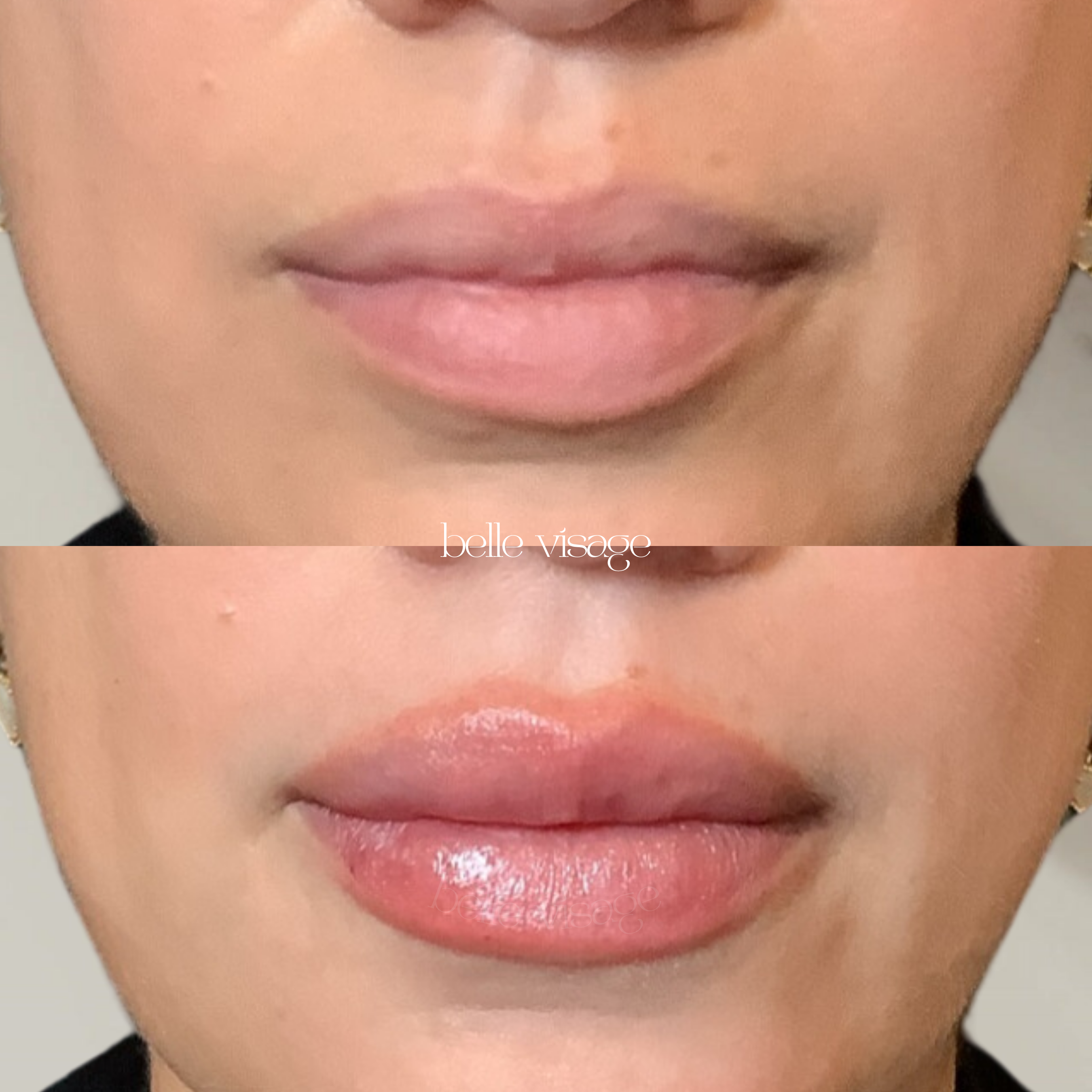 Lip Filler Treatment Burleson TX