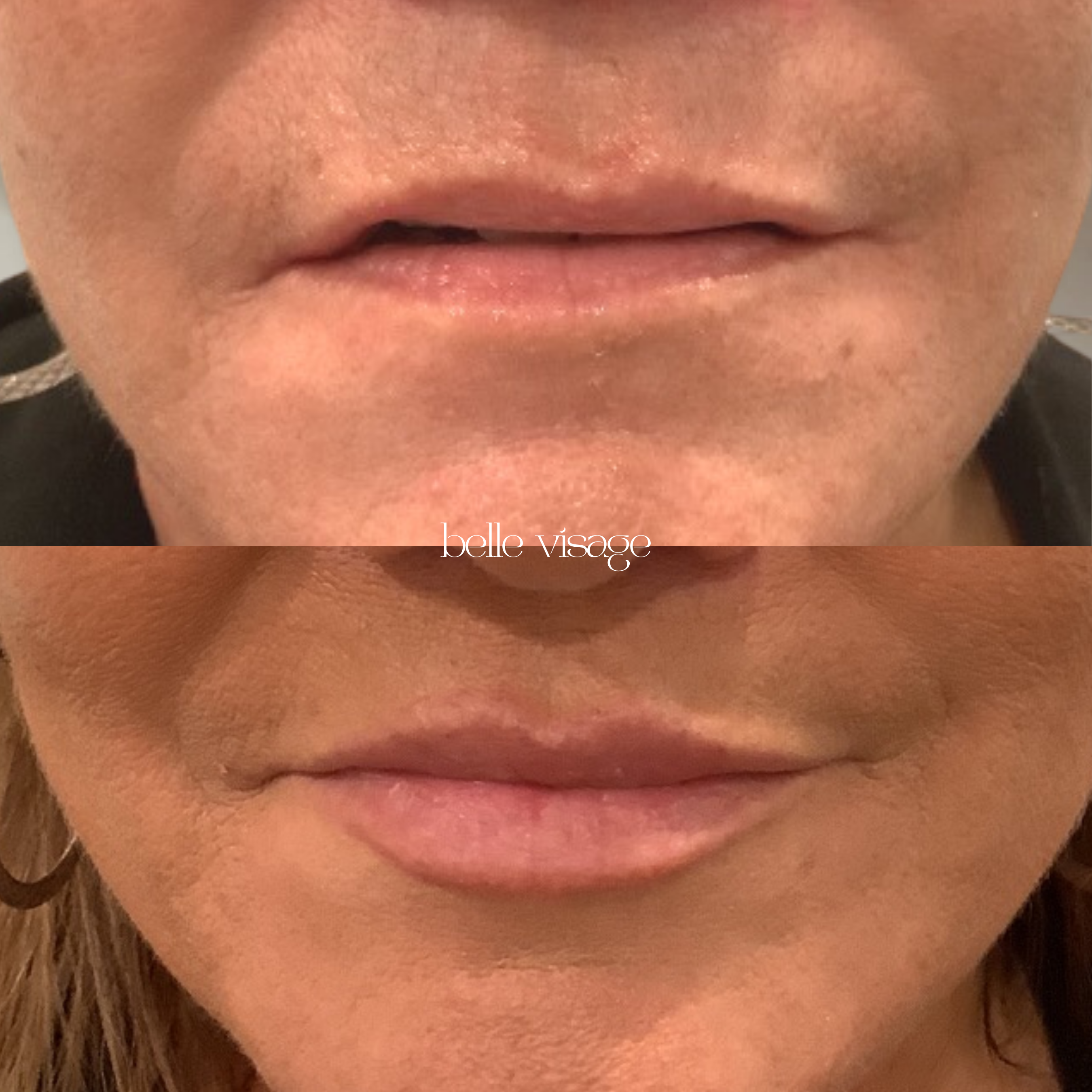 Lip Filler Treatment Burleson TX