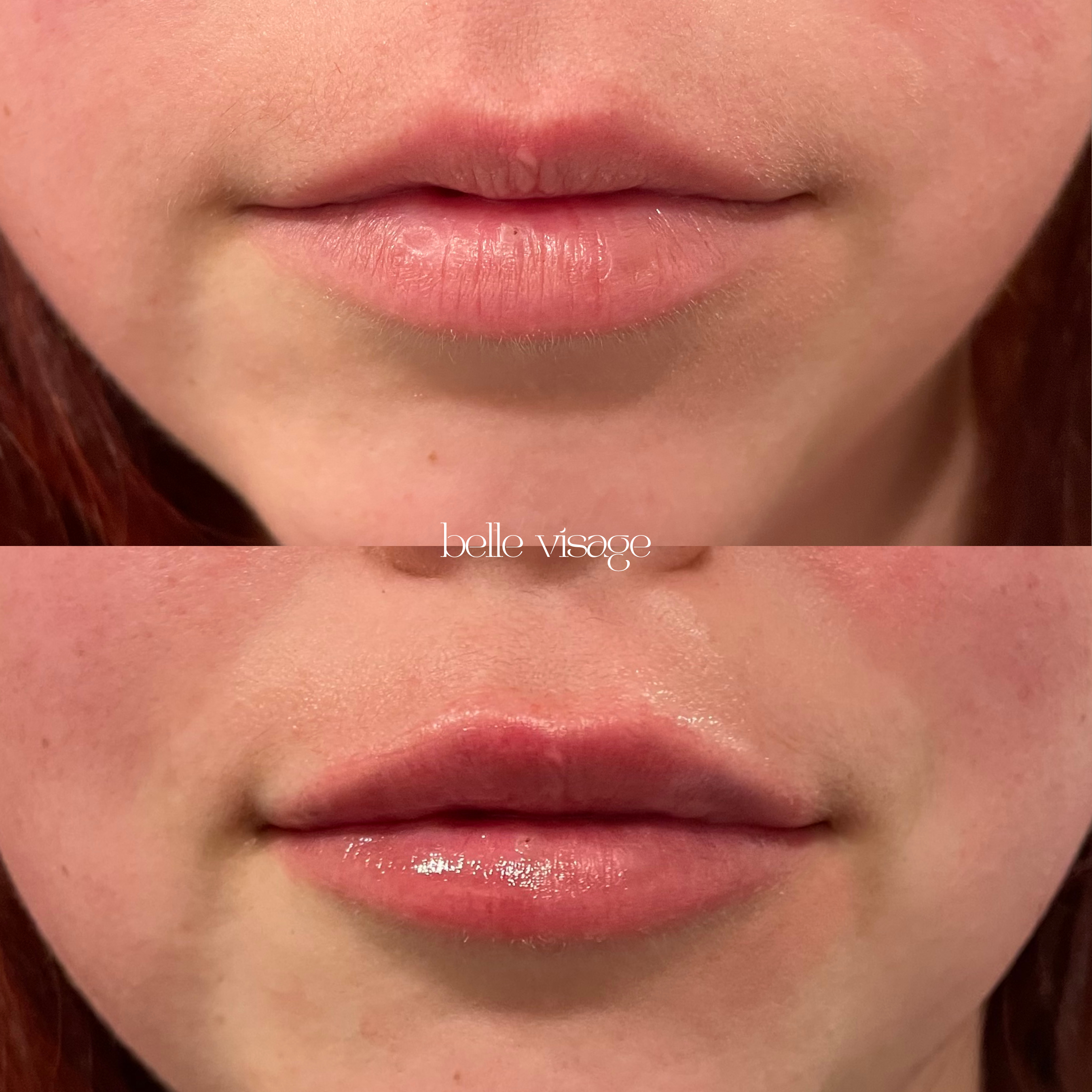 Lip Filler Treatment Burleson TX