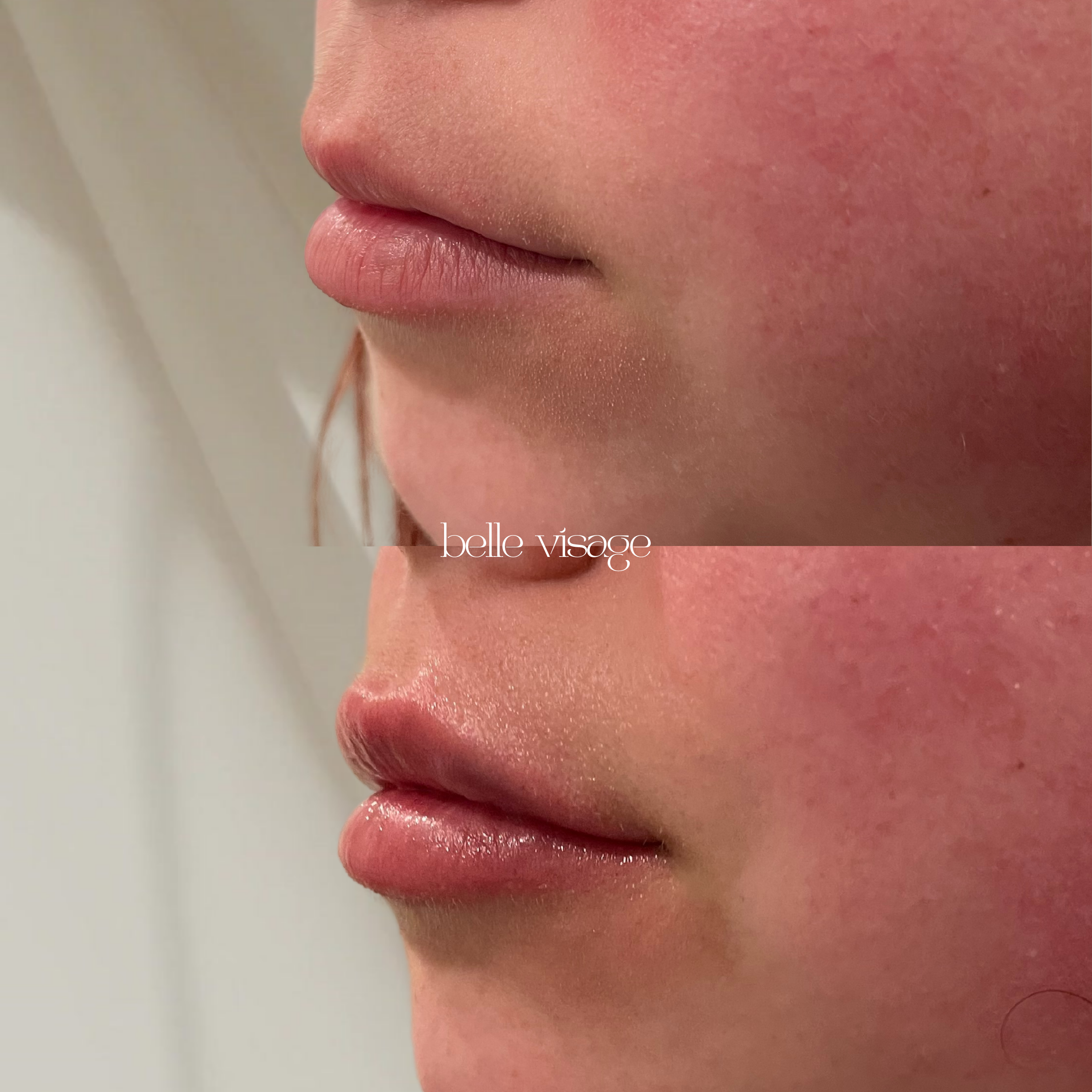 Lip Filler Treatment Burleson TX