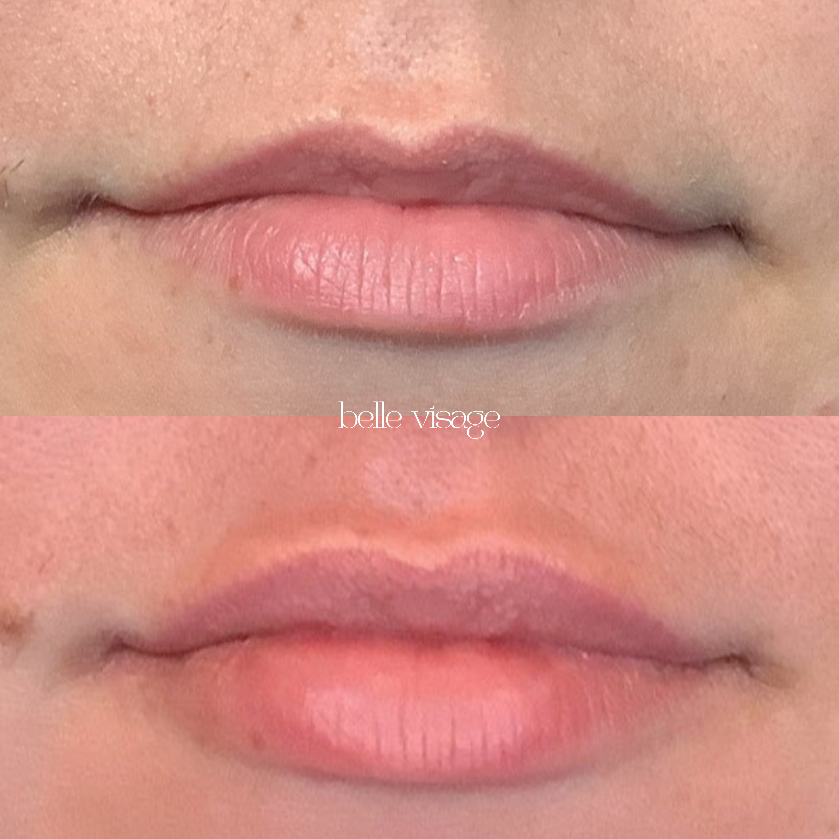 Lip Filler Treatment Burleson TX