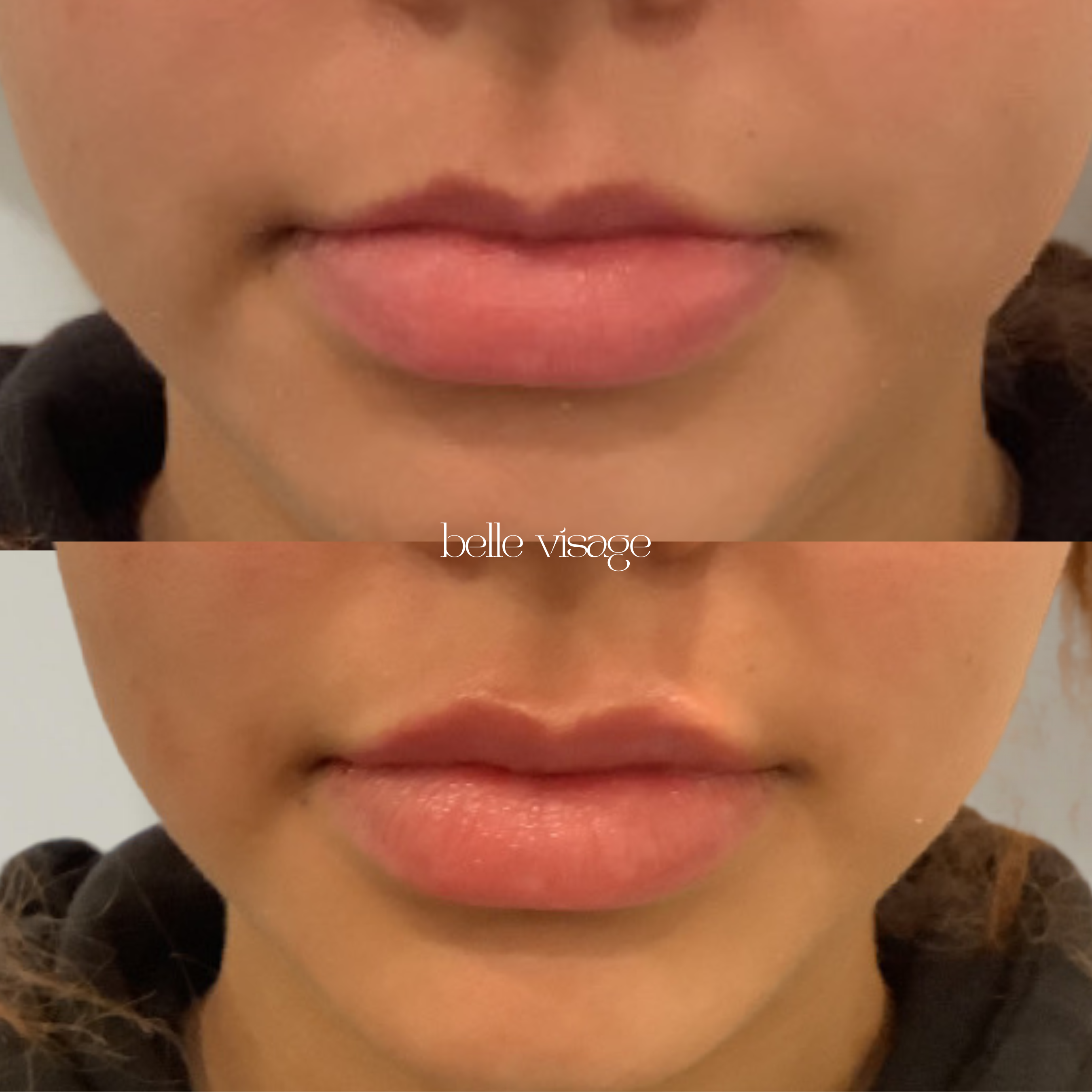 Lip Filler Treatment Burleson TX