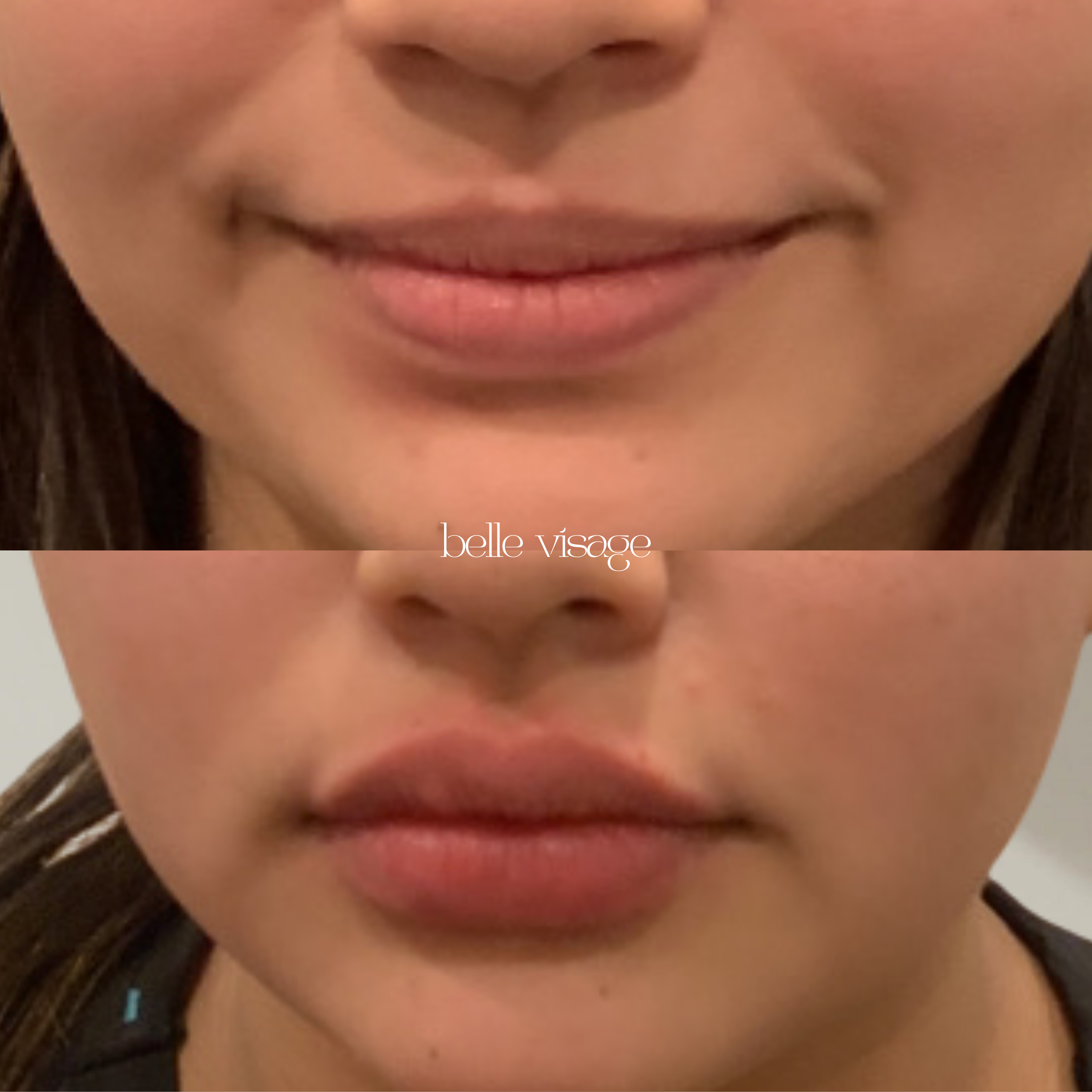 Lip Filler Treatment Burleson TX
