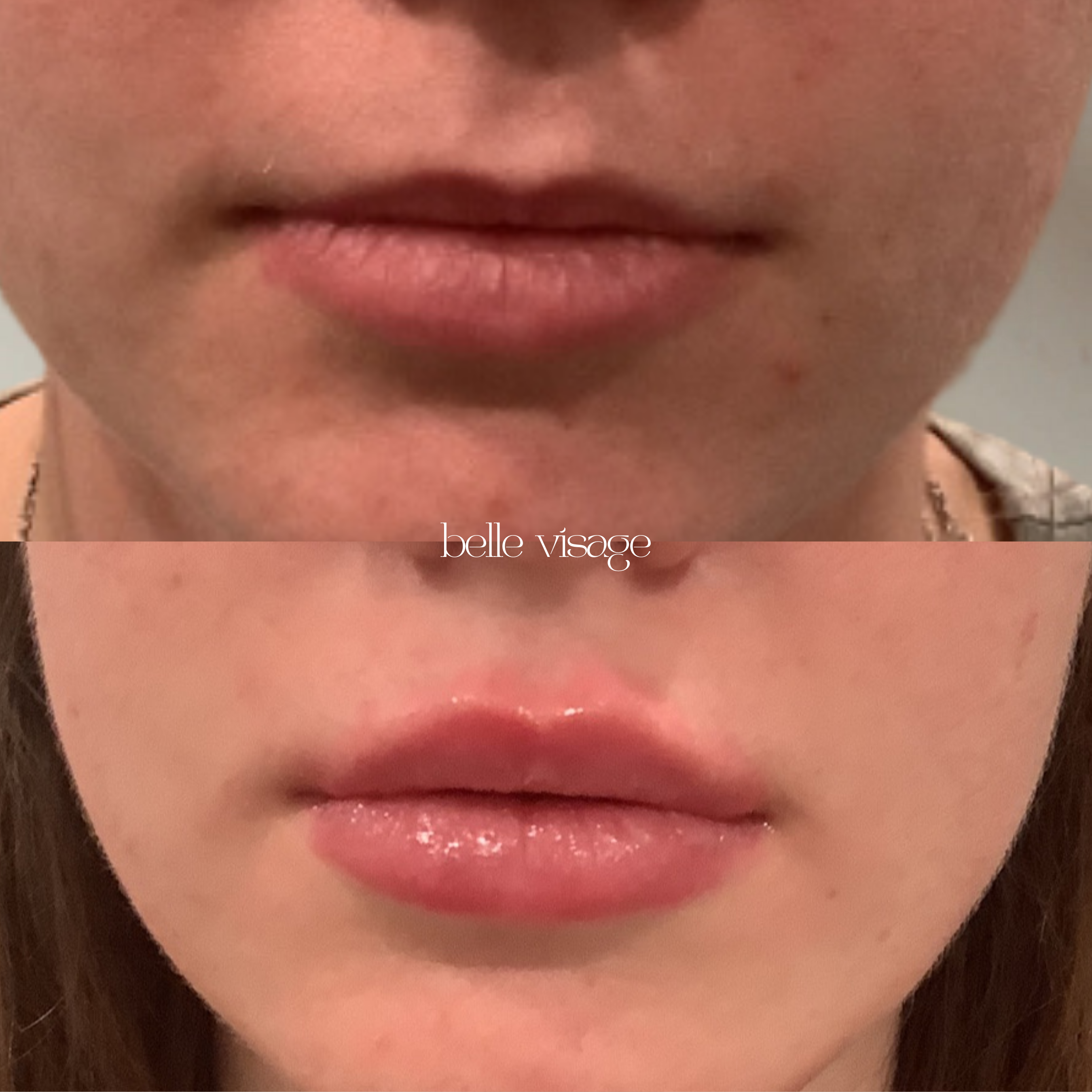 Lip Filler Treatment Burleson TX