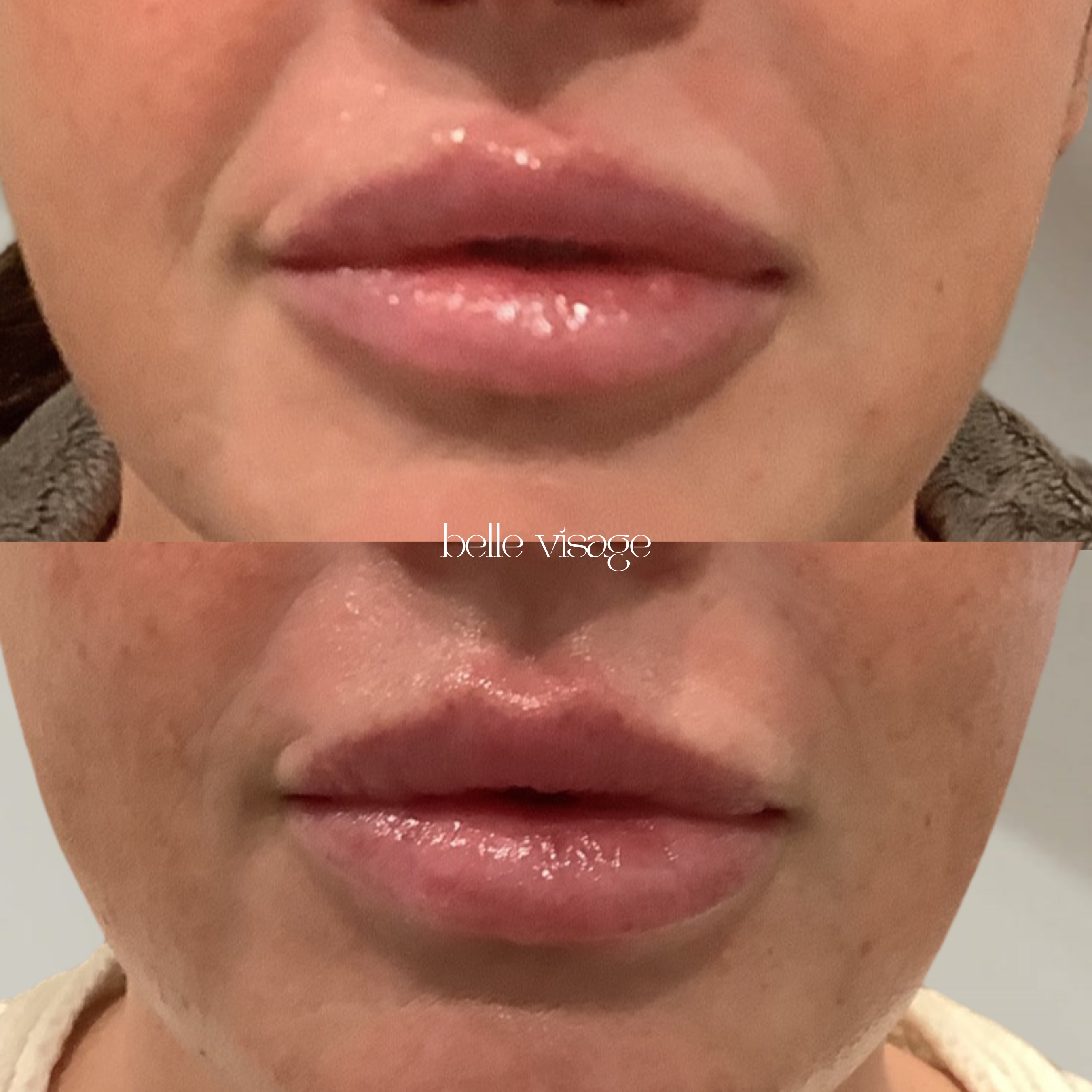 Lip Filler Treatment Burleson TX