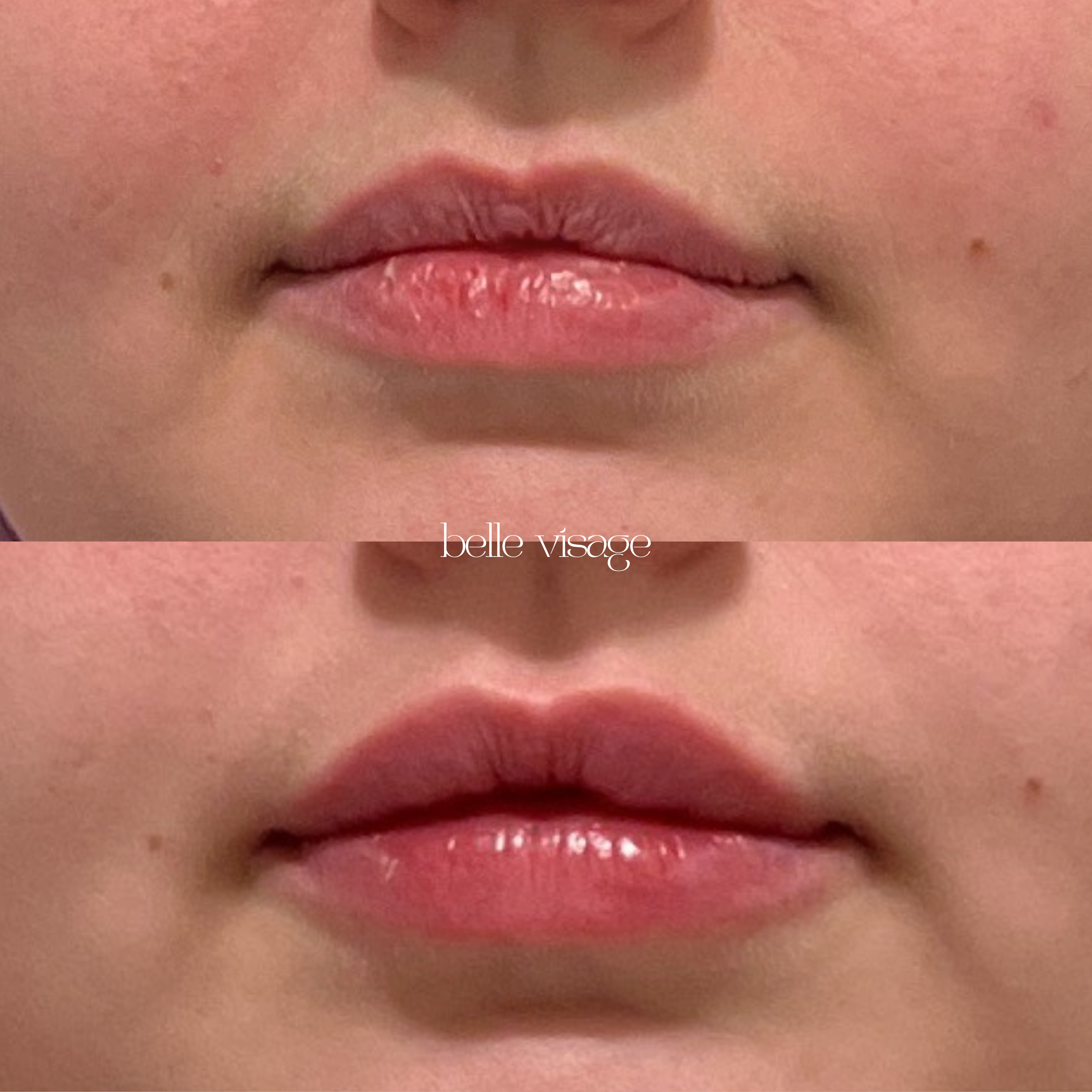 Lip Filler Treatment Burleson TX