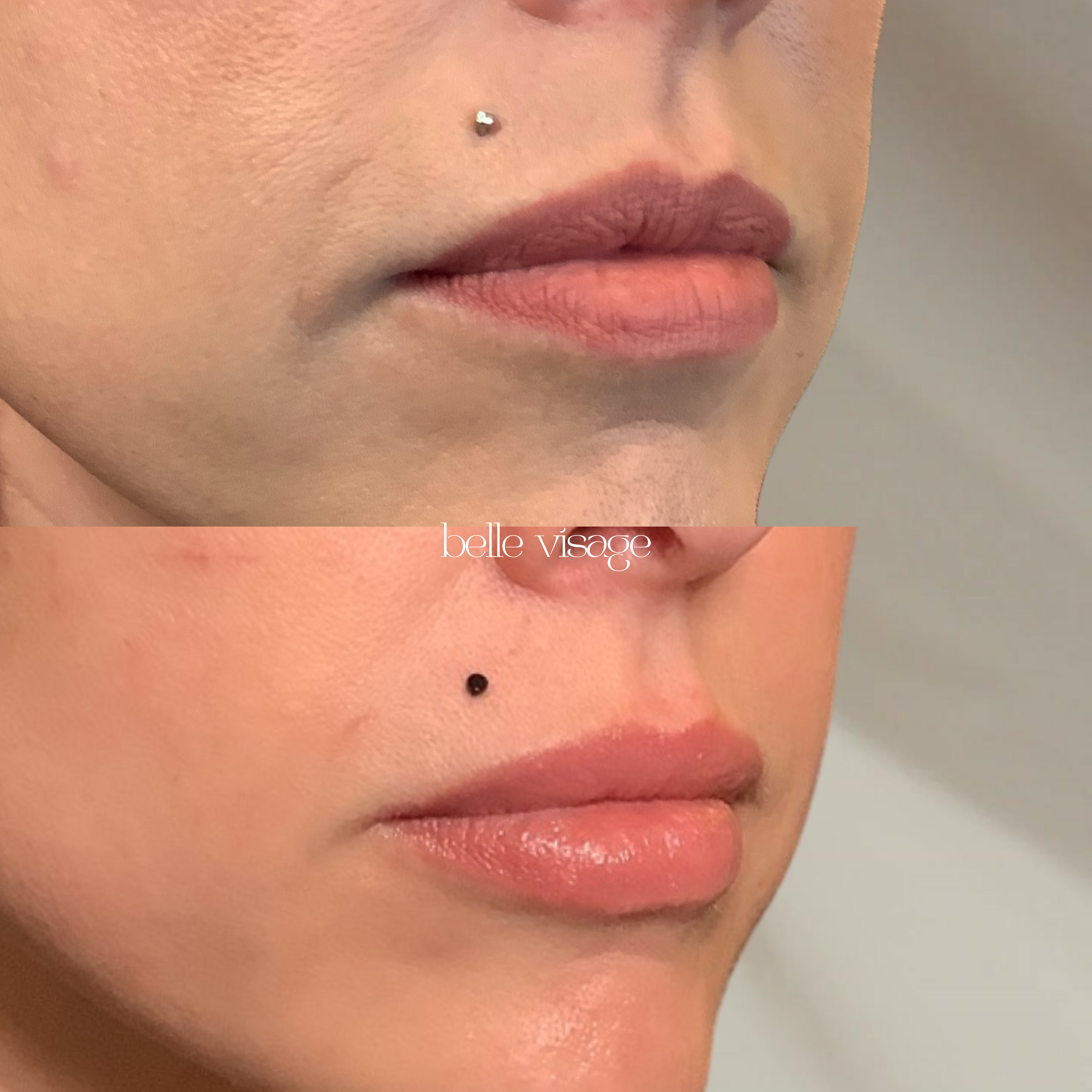 Lip Filler Treatment Burleson TX