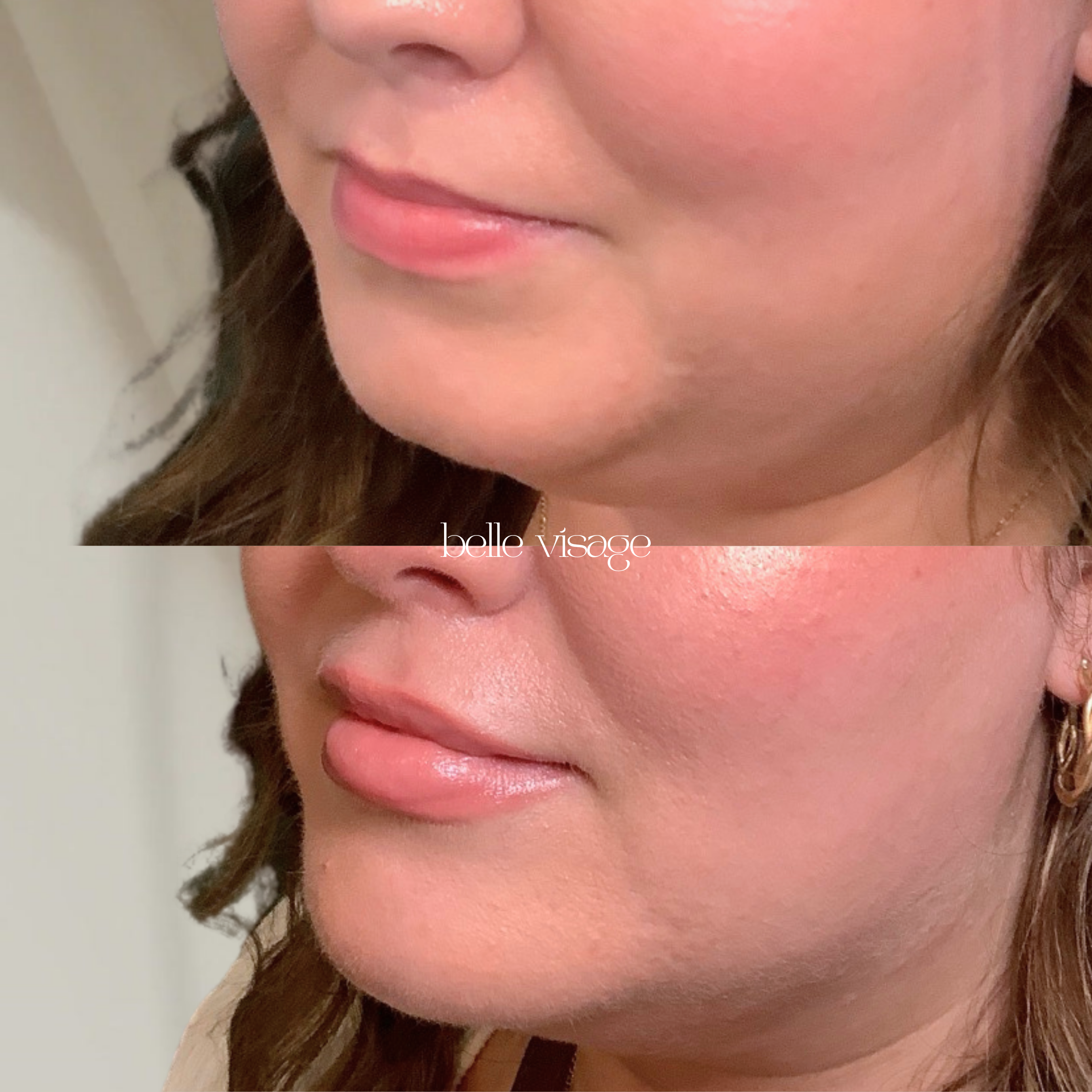 Lip Filler Treatment Burleson TX