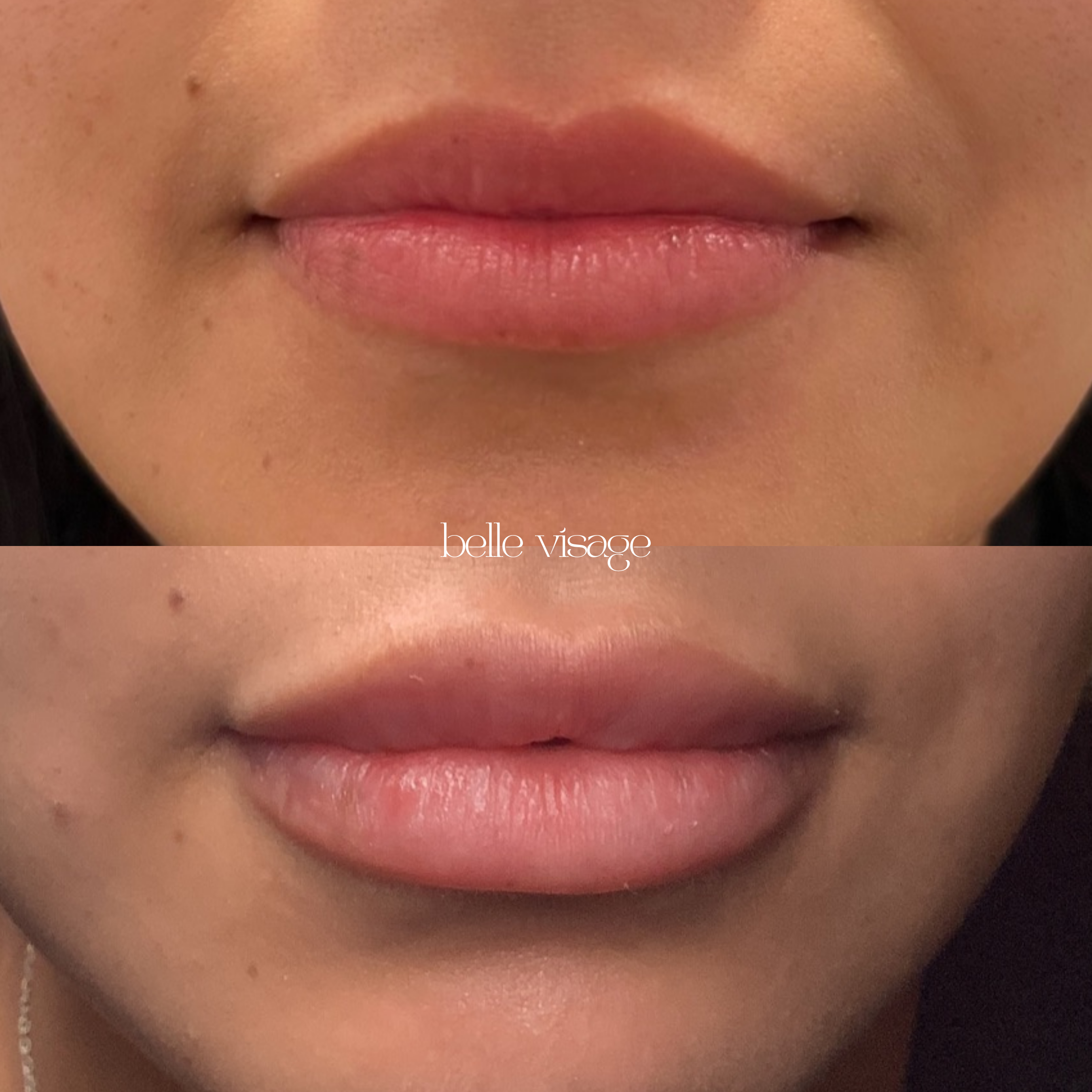 Lip Filler Treatment Burleson TX