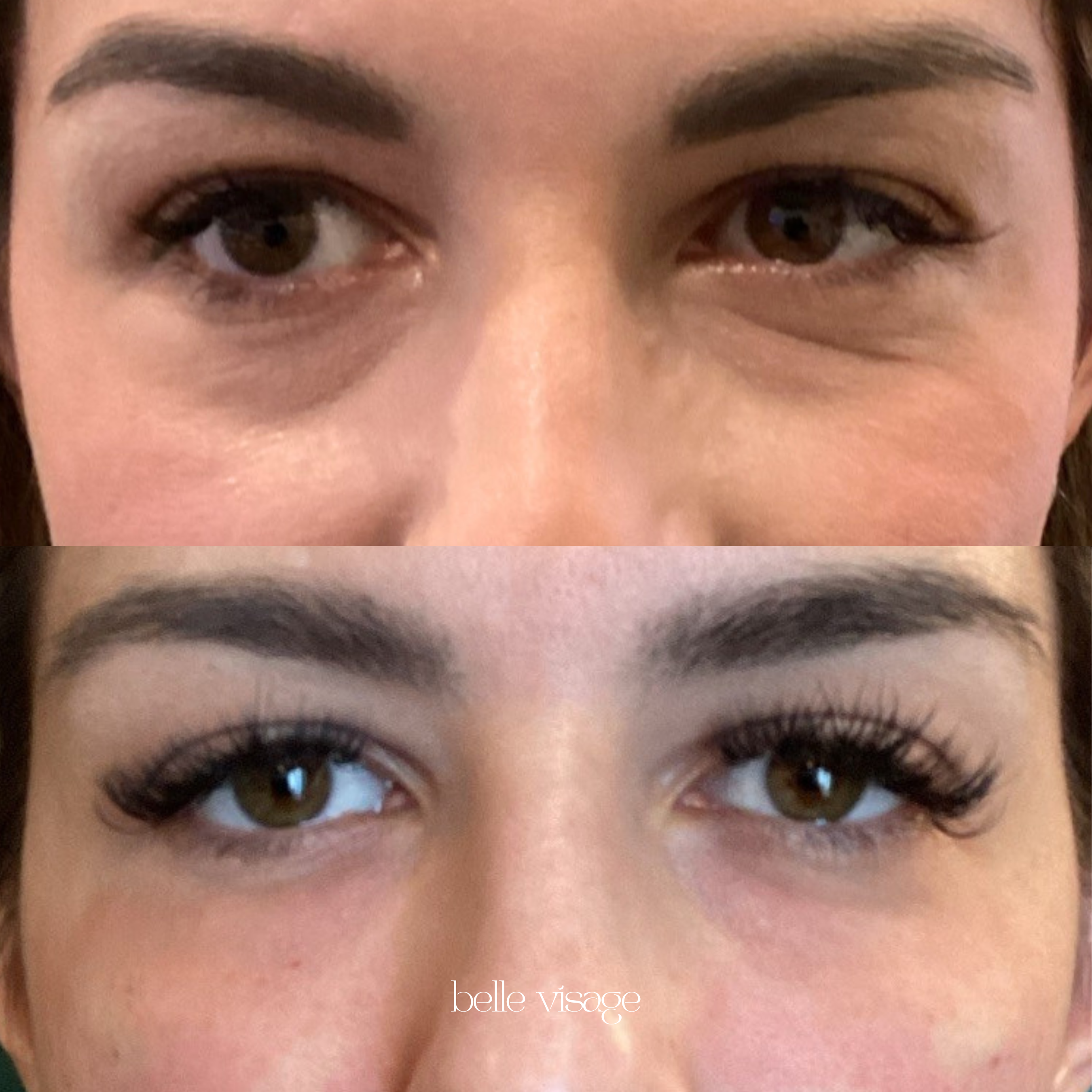 Bio Filler EZ Gel PRF Biostimulator Injectable Treatment Burleson TX