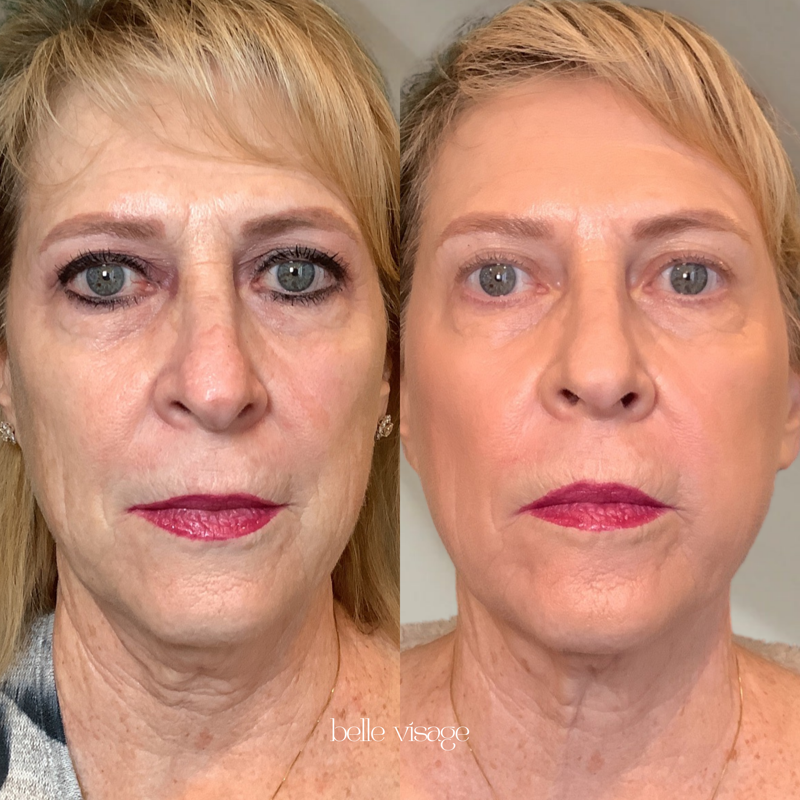 radio frequency rf microneedling treatment burleson tx