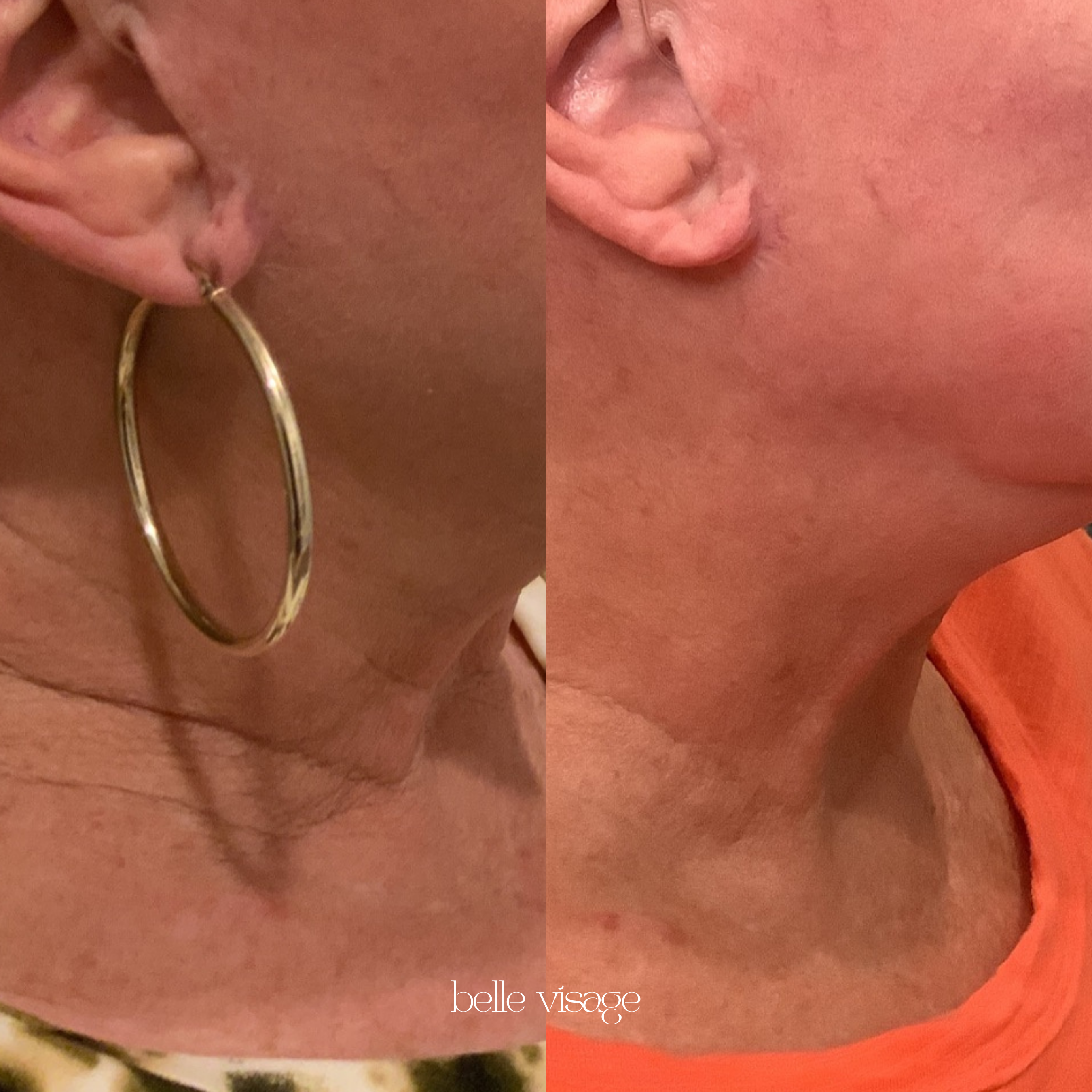 radio frequency rf microneedling treatment burleson tx