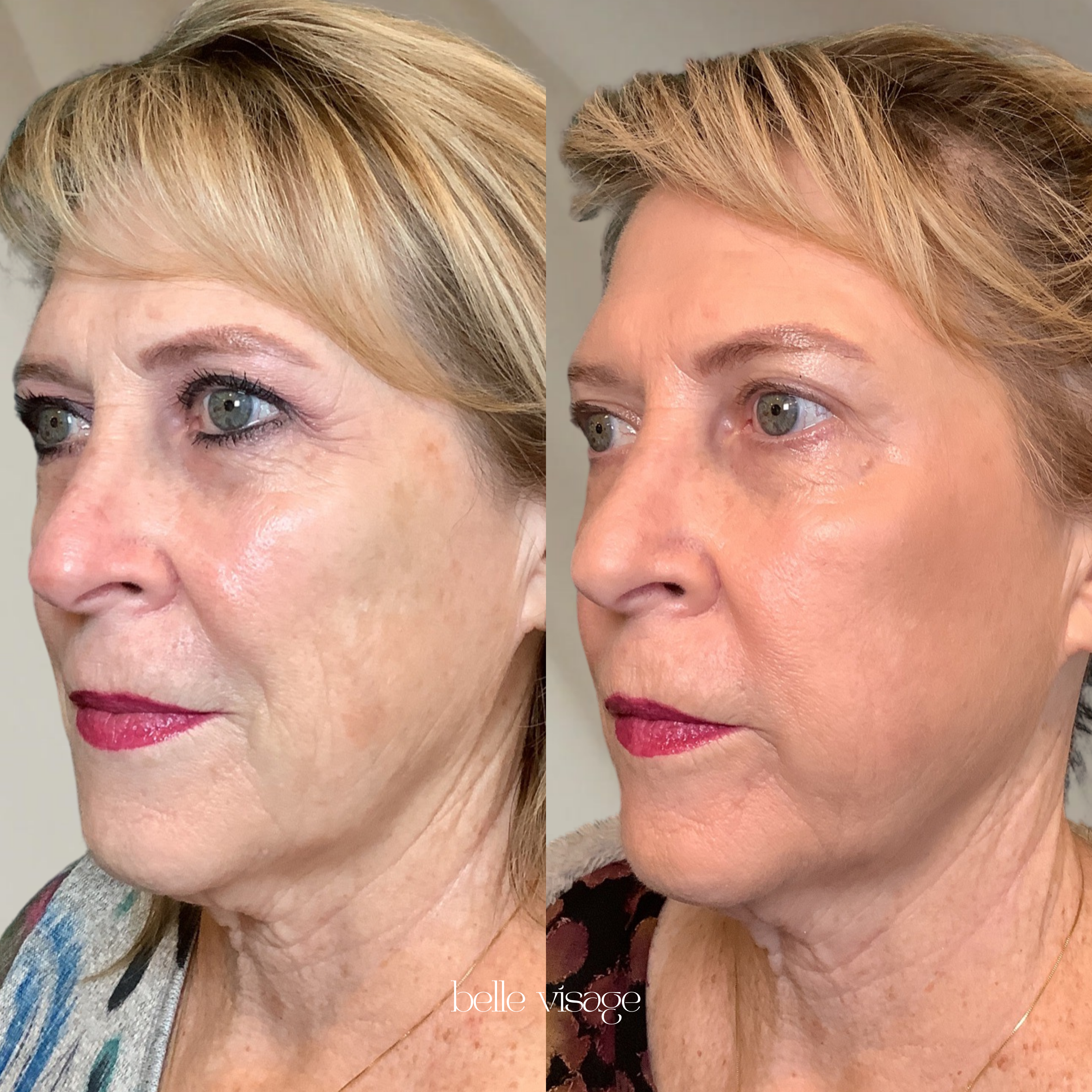 radio frequency rf microneedling treatment burleson tx