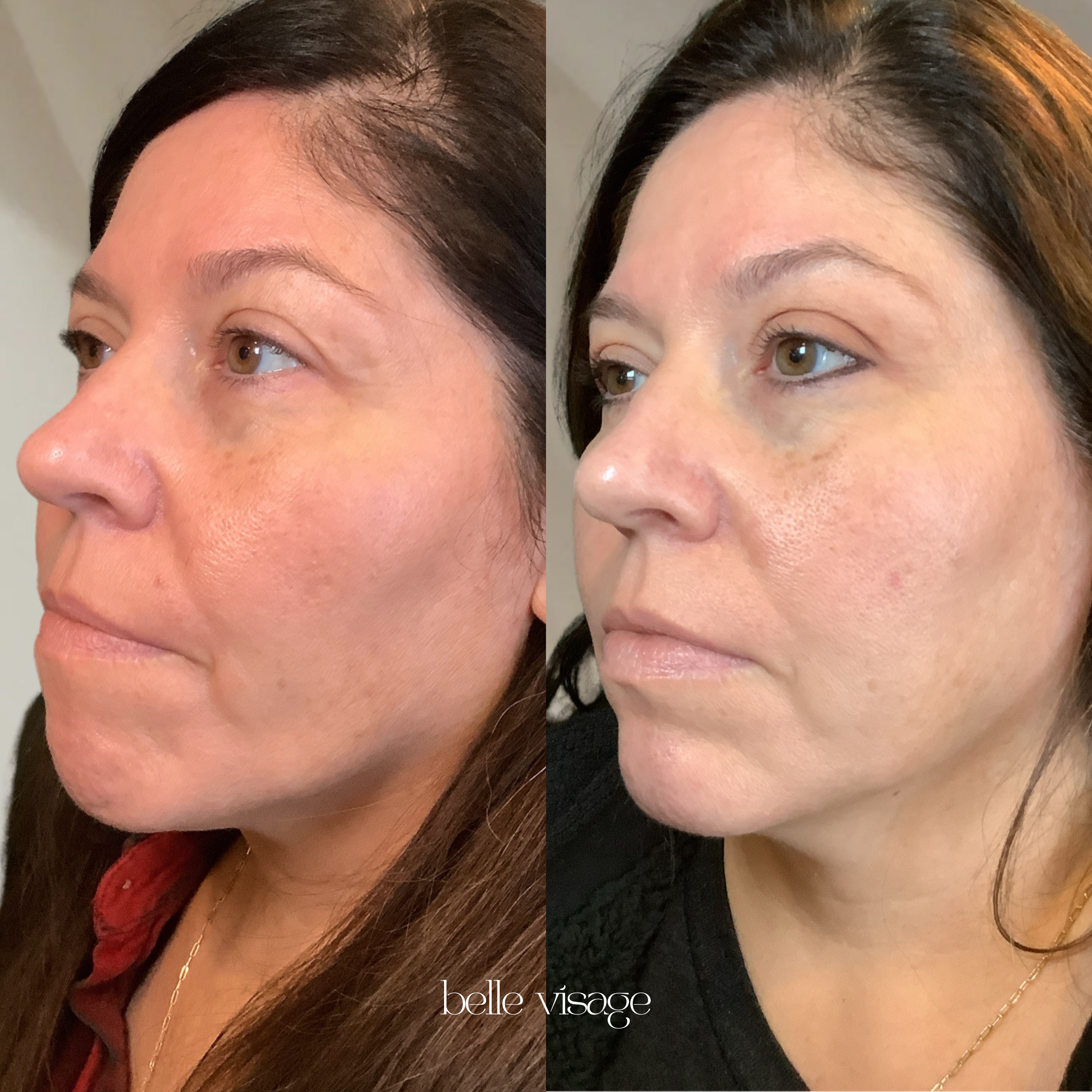 Sculptra Biostimulator Injectable Treatment Burleson TX