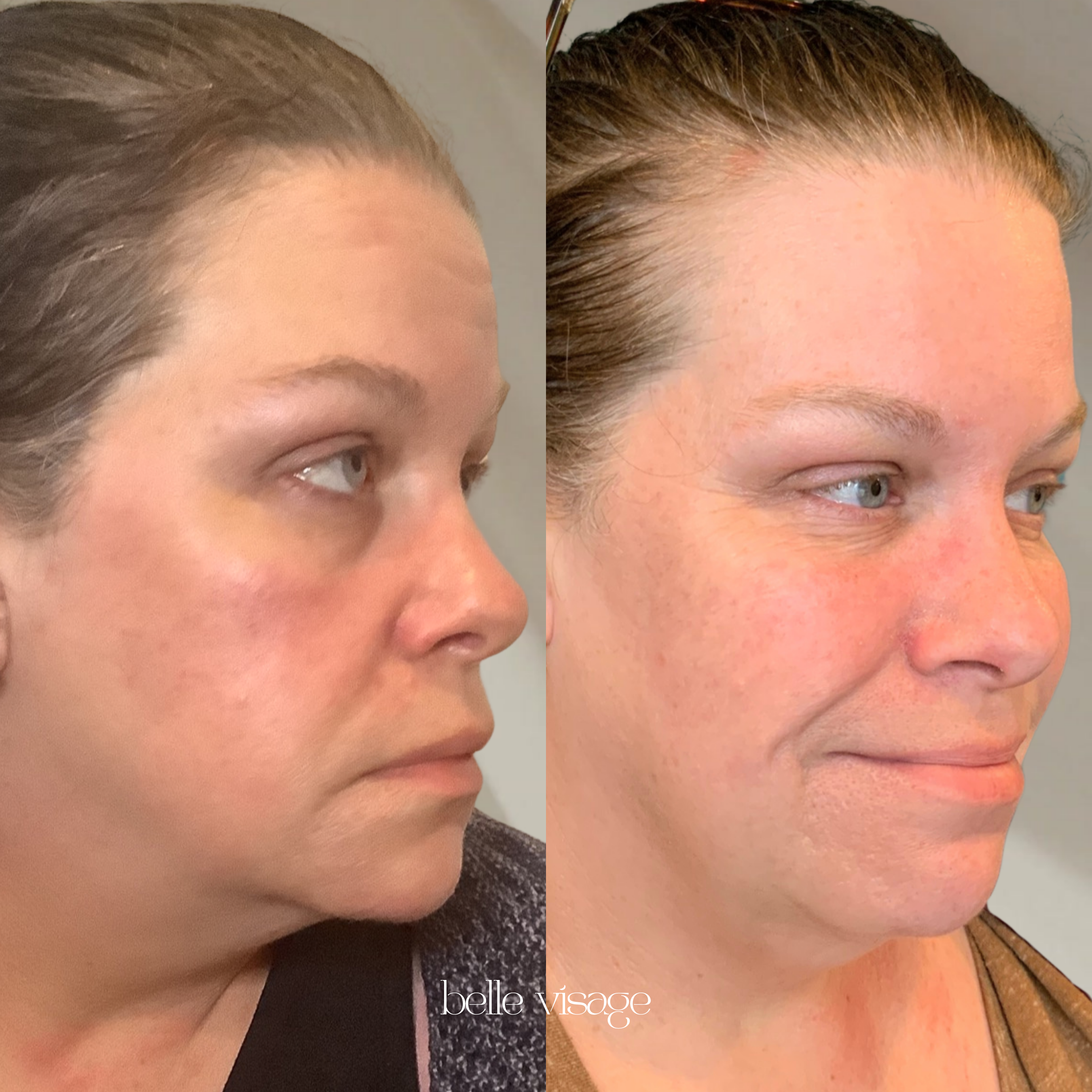 Sculptra Biostimulator Injectable Treatment Burleson TX