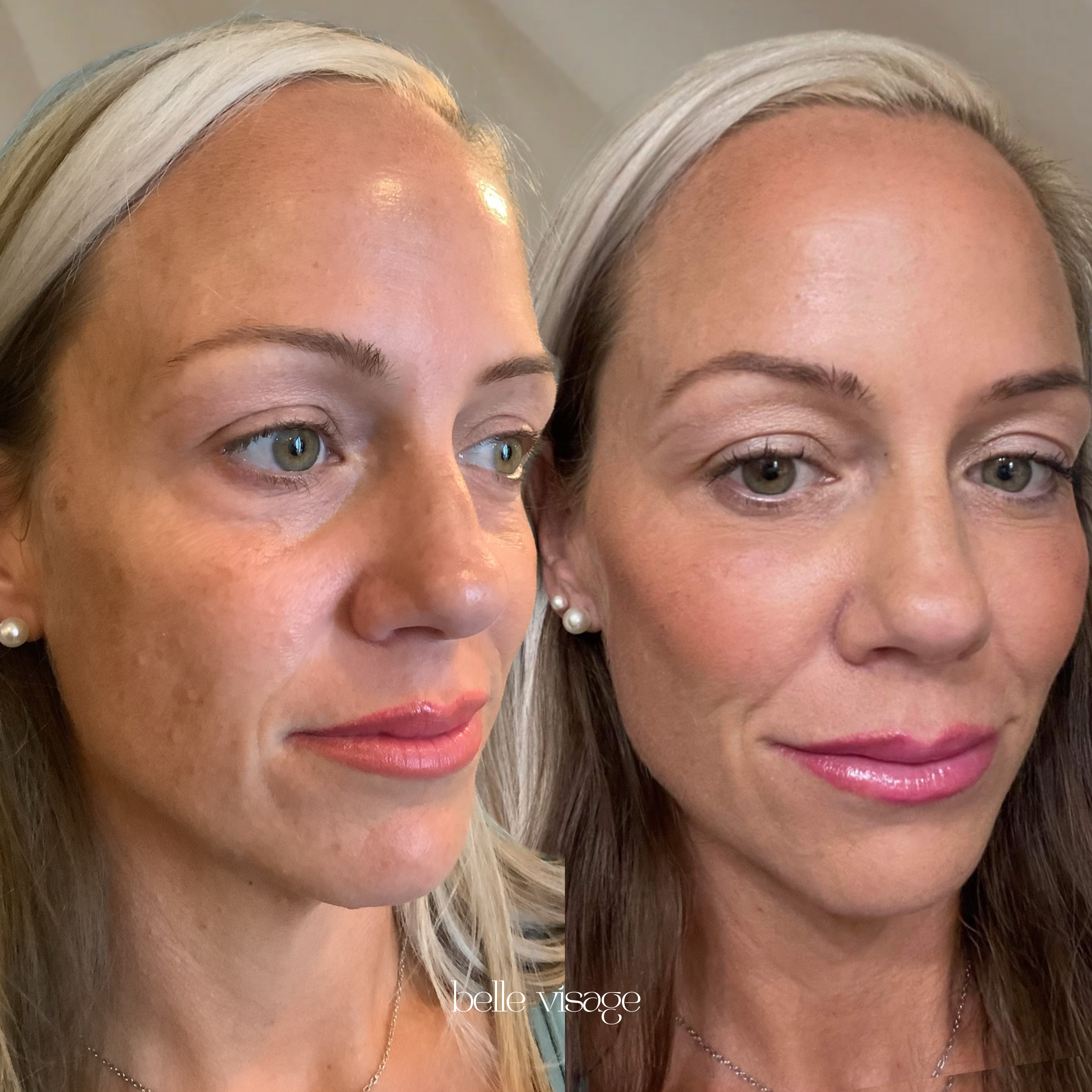 Sculptra Biostimulator Injectable Treatment Burleson TX