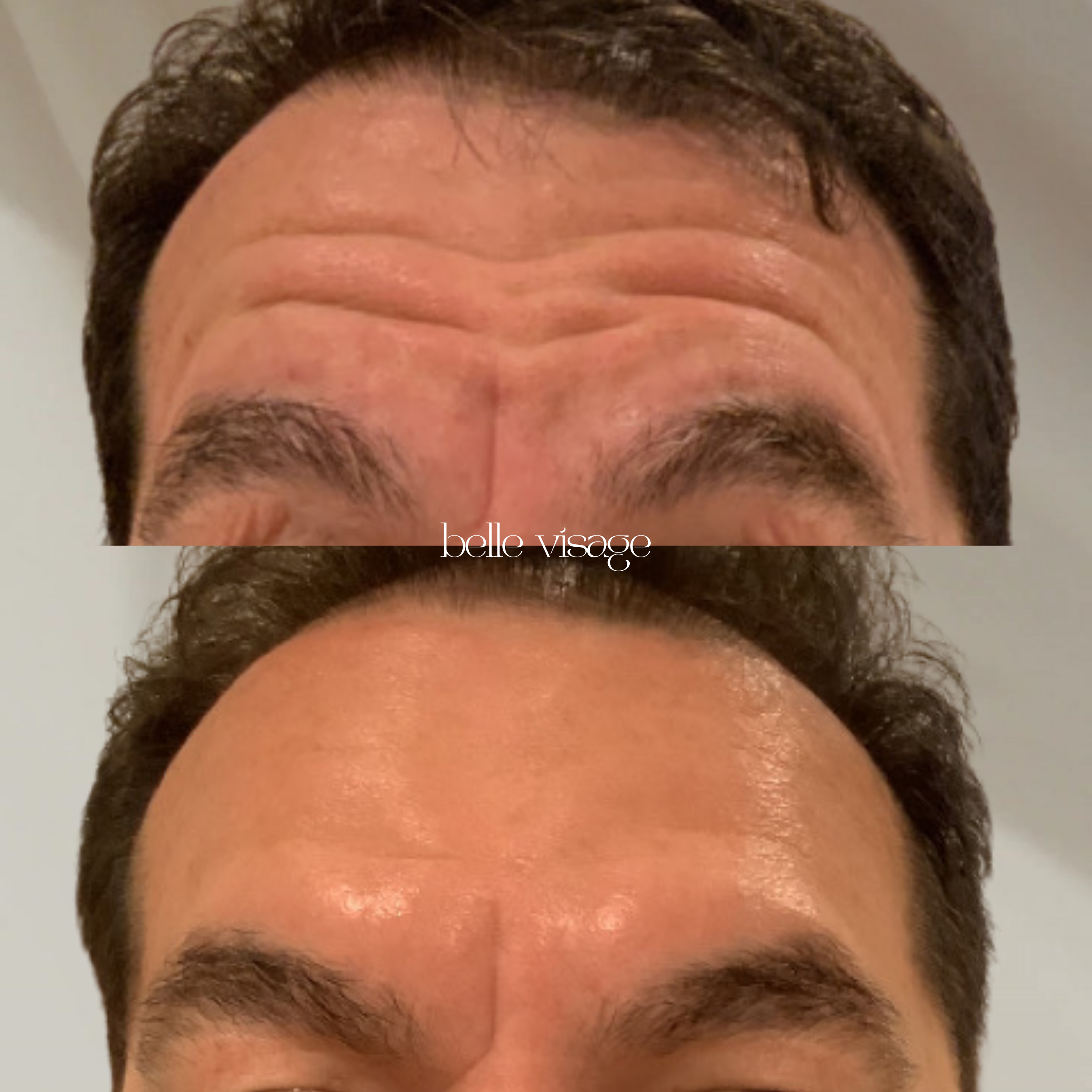 Tox Botox Dysport Xeomin Neurotoxin Treatment Burleson TX