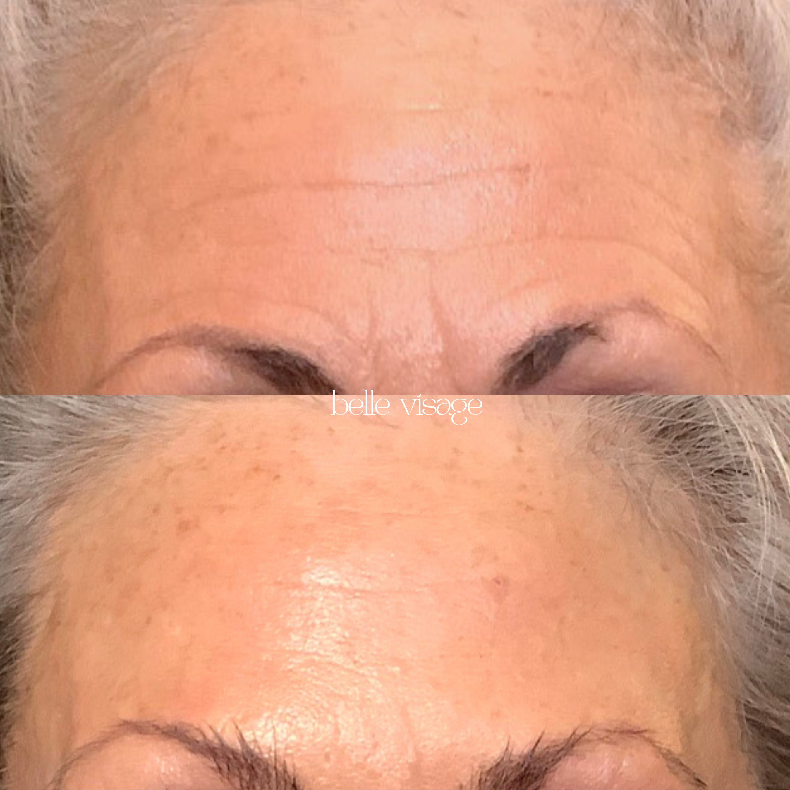 Tox Botox Dysport Xeomin Neurotoxin Treatment Burleson TX