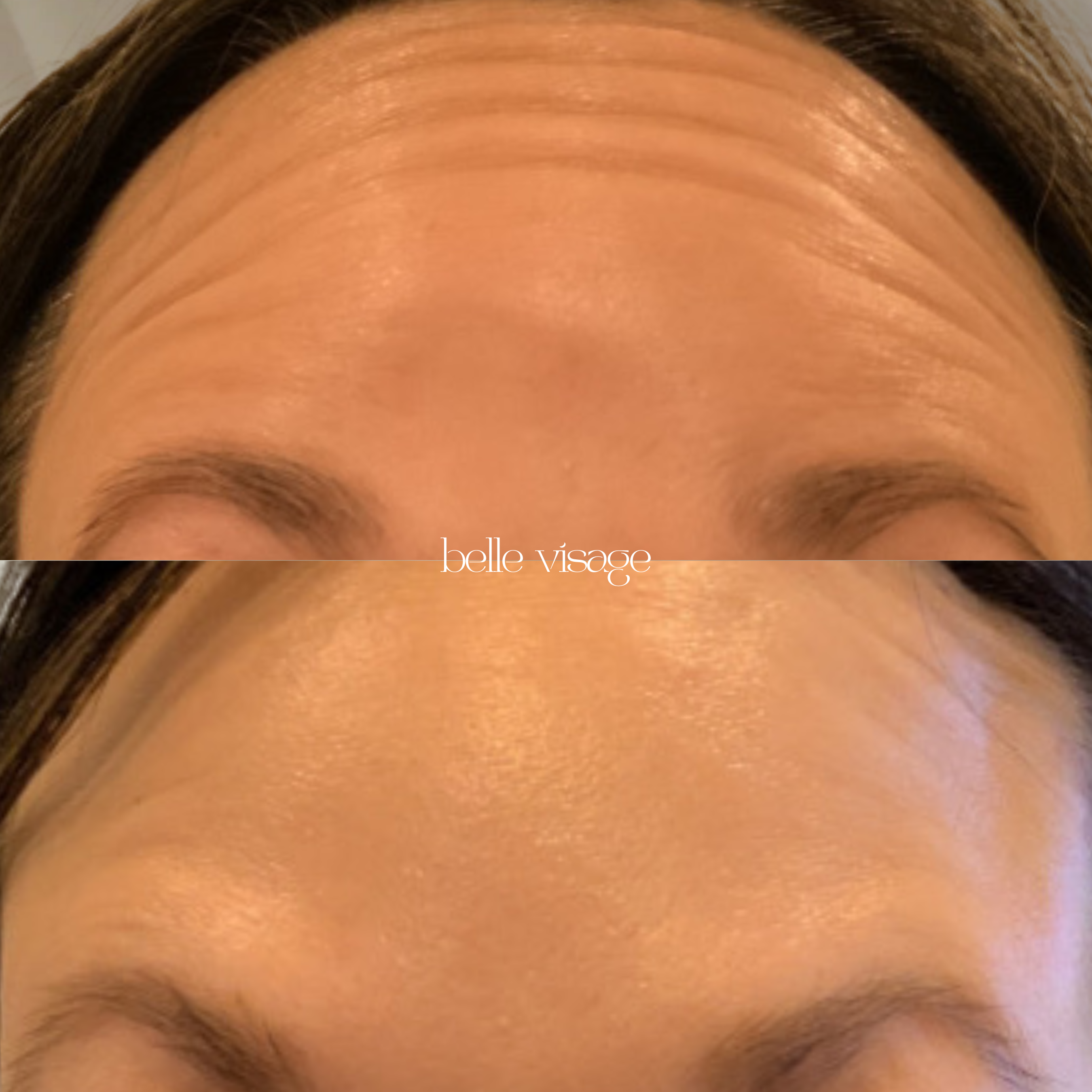 Tox Botox Dysport Xeomin Neurotoxin Treatment Burleson TX