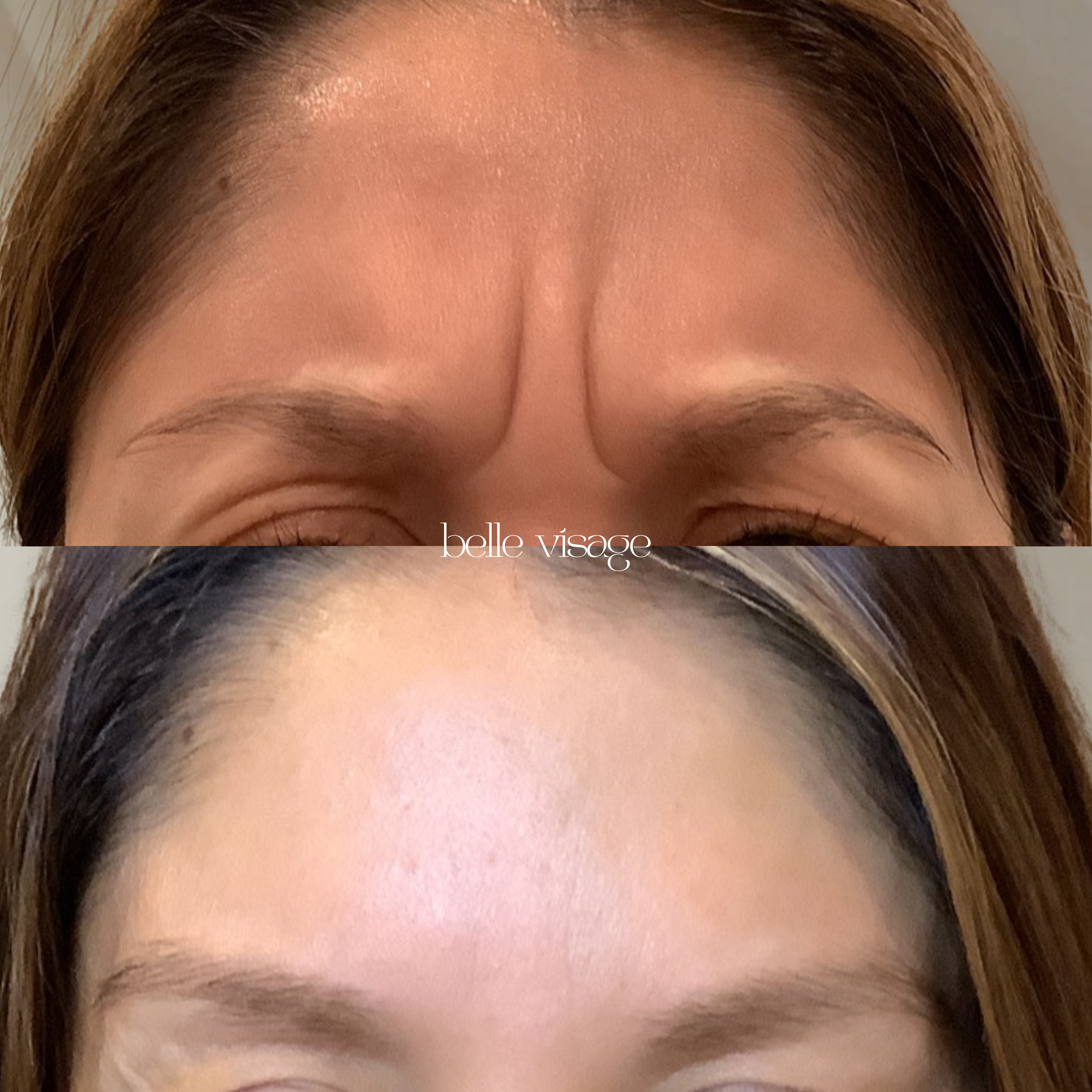 Tox Botox Dysport Xeomin Neurotoxin Treatment Burleson TX