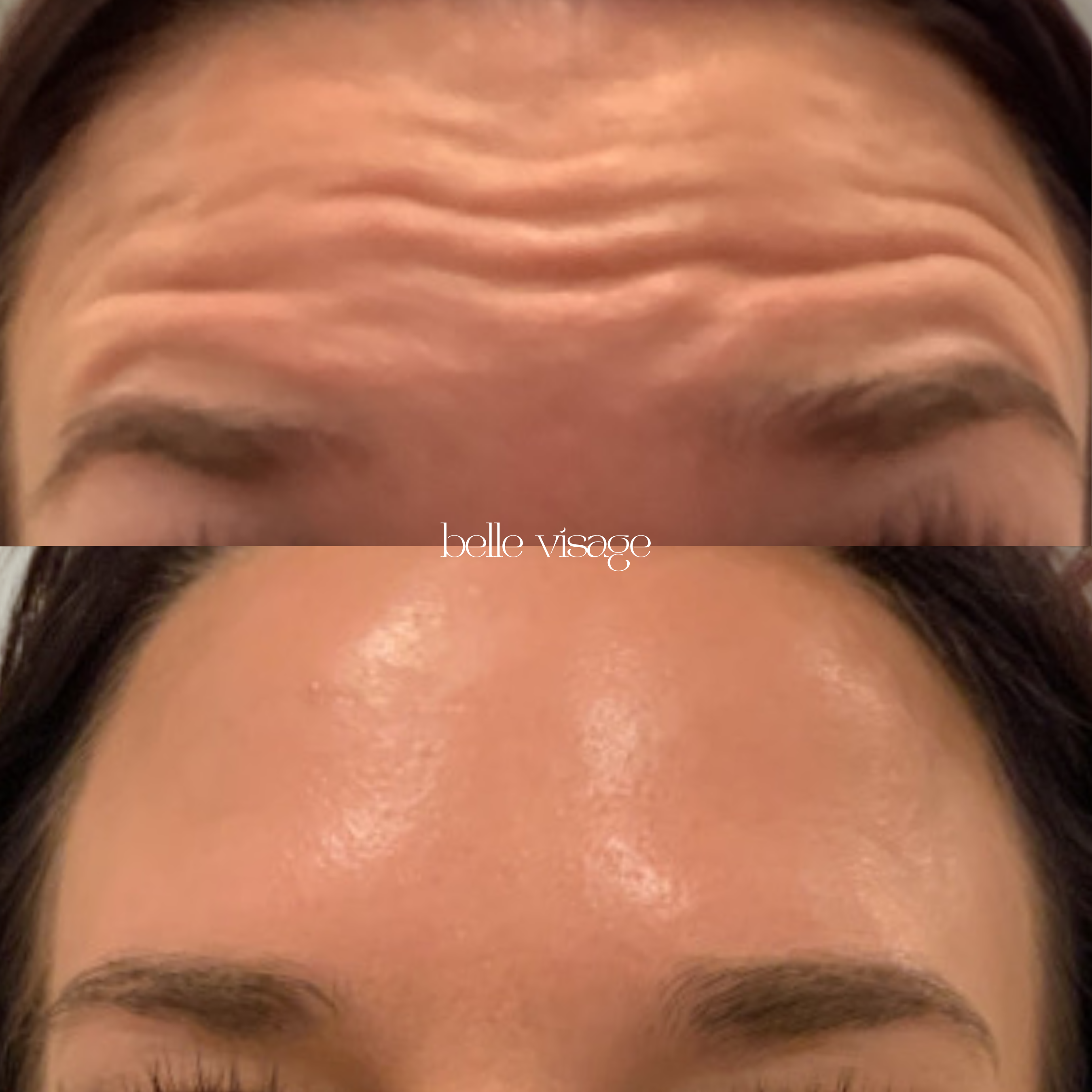 Tox Botox Dysport Xeomin Neurotoxin Treatment Burleson TX