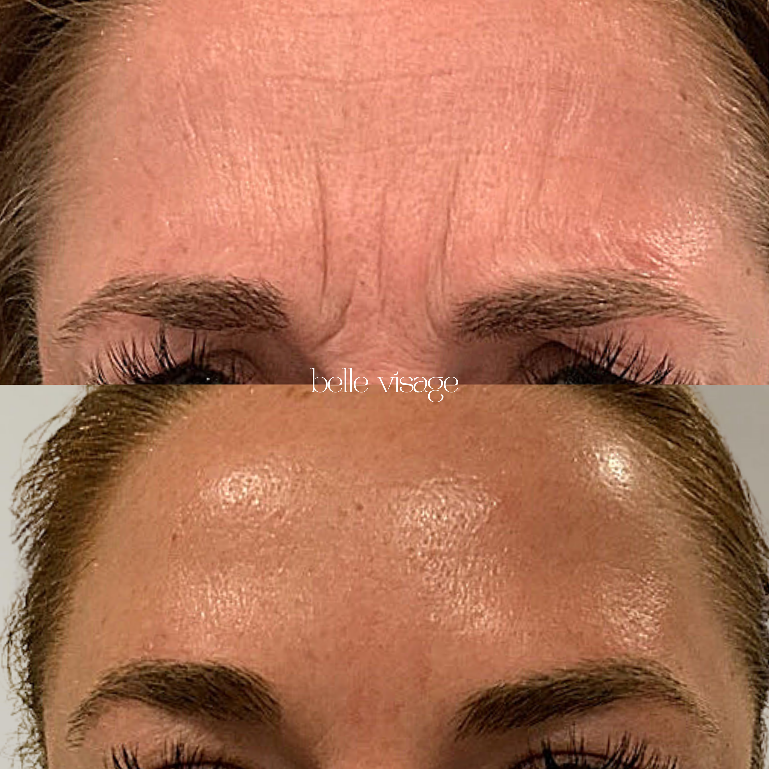 Tox Botox Dysport Xeomin Neurotoxin Treatment Burleson TX
