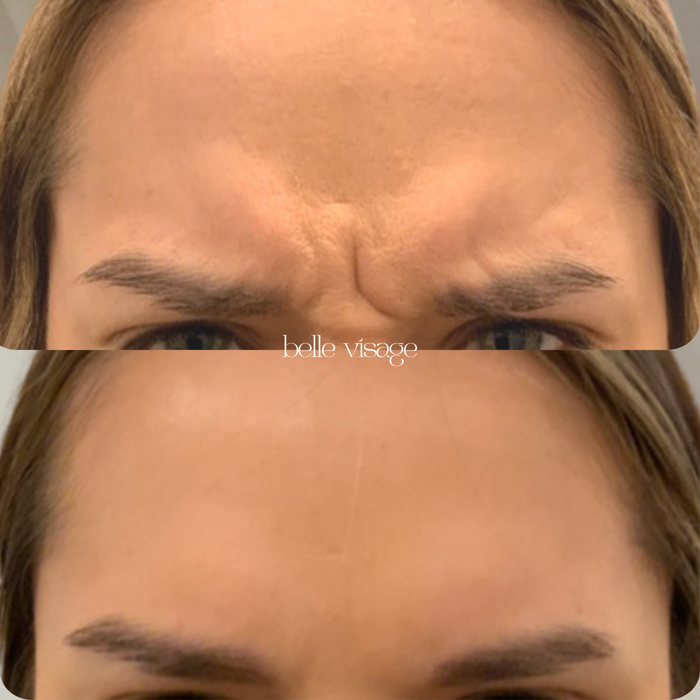 Tox Botox Dysport Xeomin Neurotoxin Treatment Burleson TX